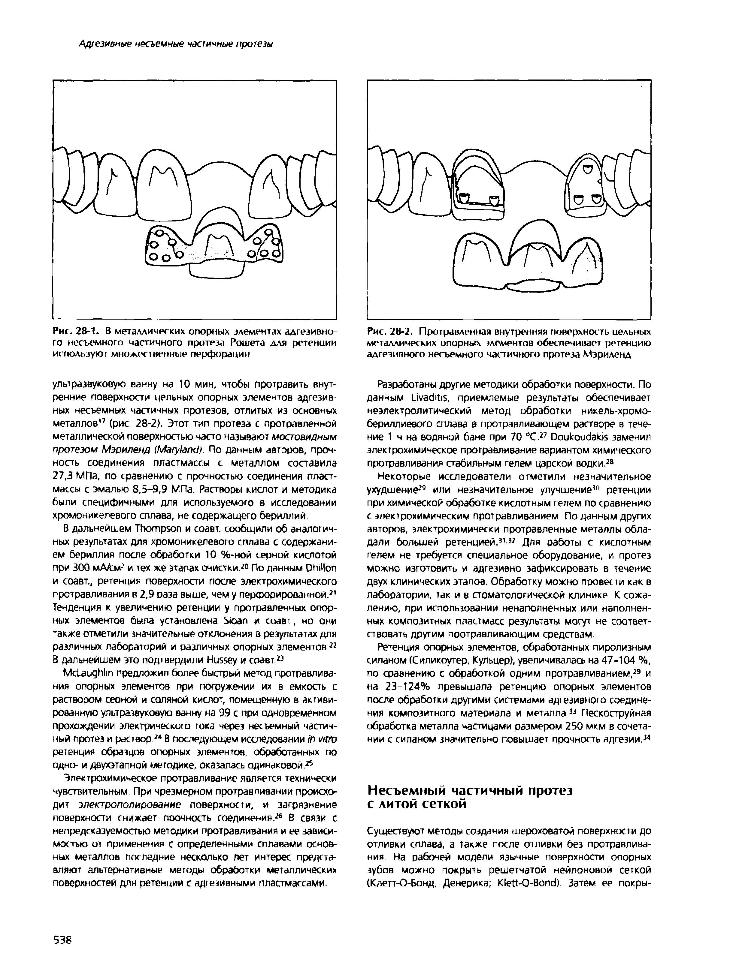Рис. 28-1. В металлических опорных элементах адгезивного несъемного частичного протеза Рошета для ретенции используют множественные перфорации...