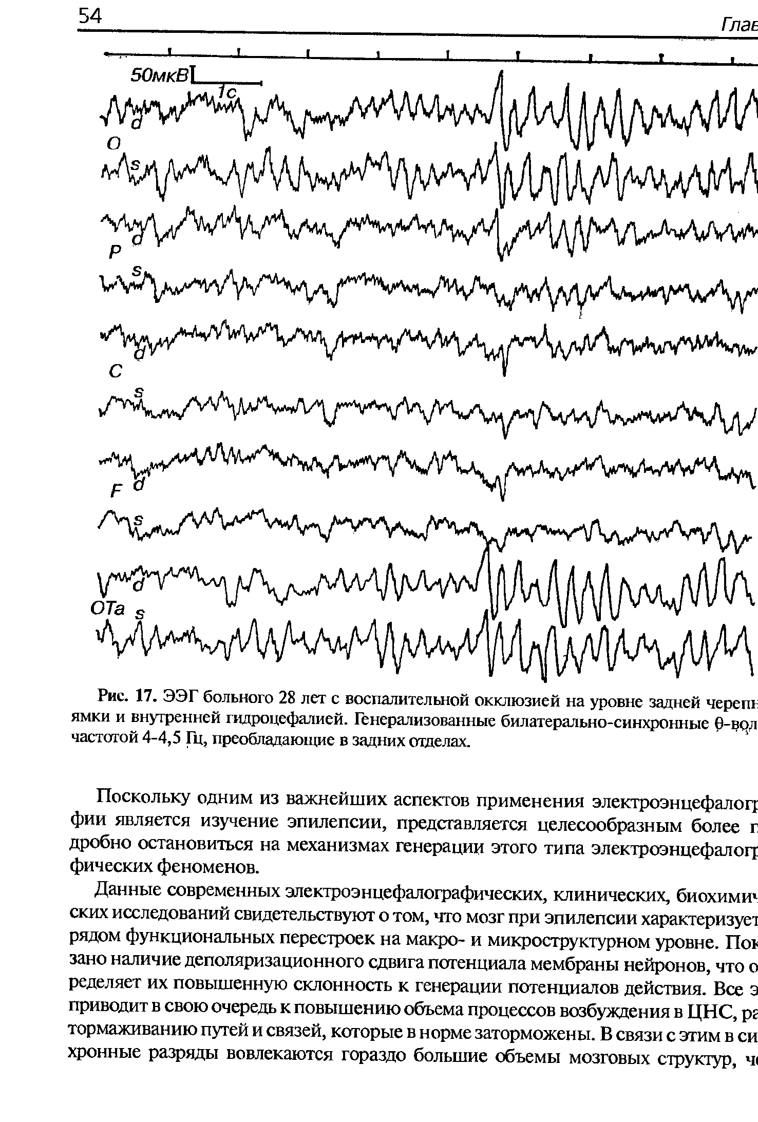 Рис. 17. ЭЭГ больного 28 лет с воспалительной окклюзией на уровне задней черепг ямки и внутренней гидроцефалией. Генерализованные билатерально-синхронные 0-врд частотой 4-4,5 Гц, преобладающие в задних отделах.