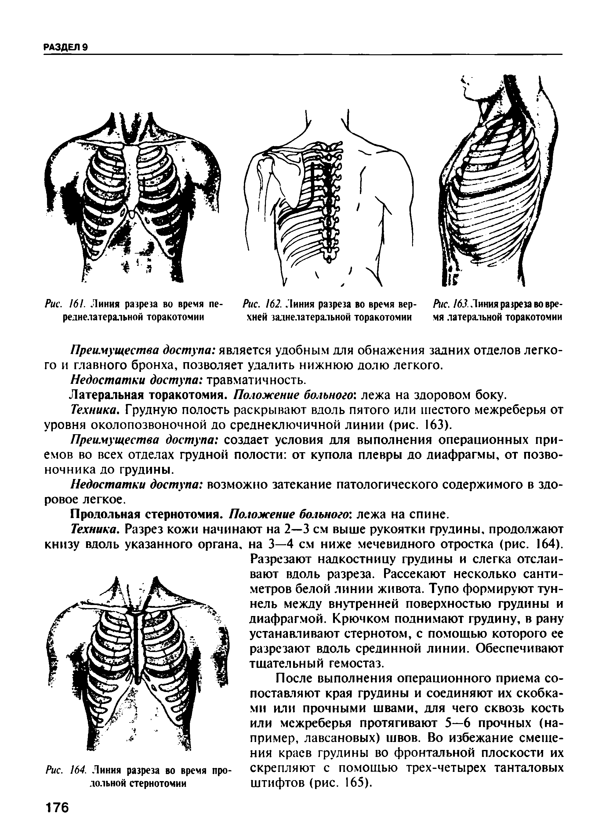 Рис. 162. Линия разреза во время вер- Рис. 163. Линия разреза во вре-хней заднелатеральной торакотомии мя латеральной торакотомии...