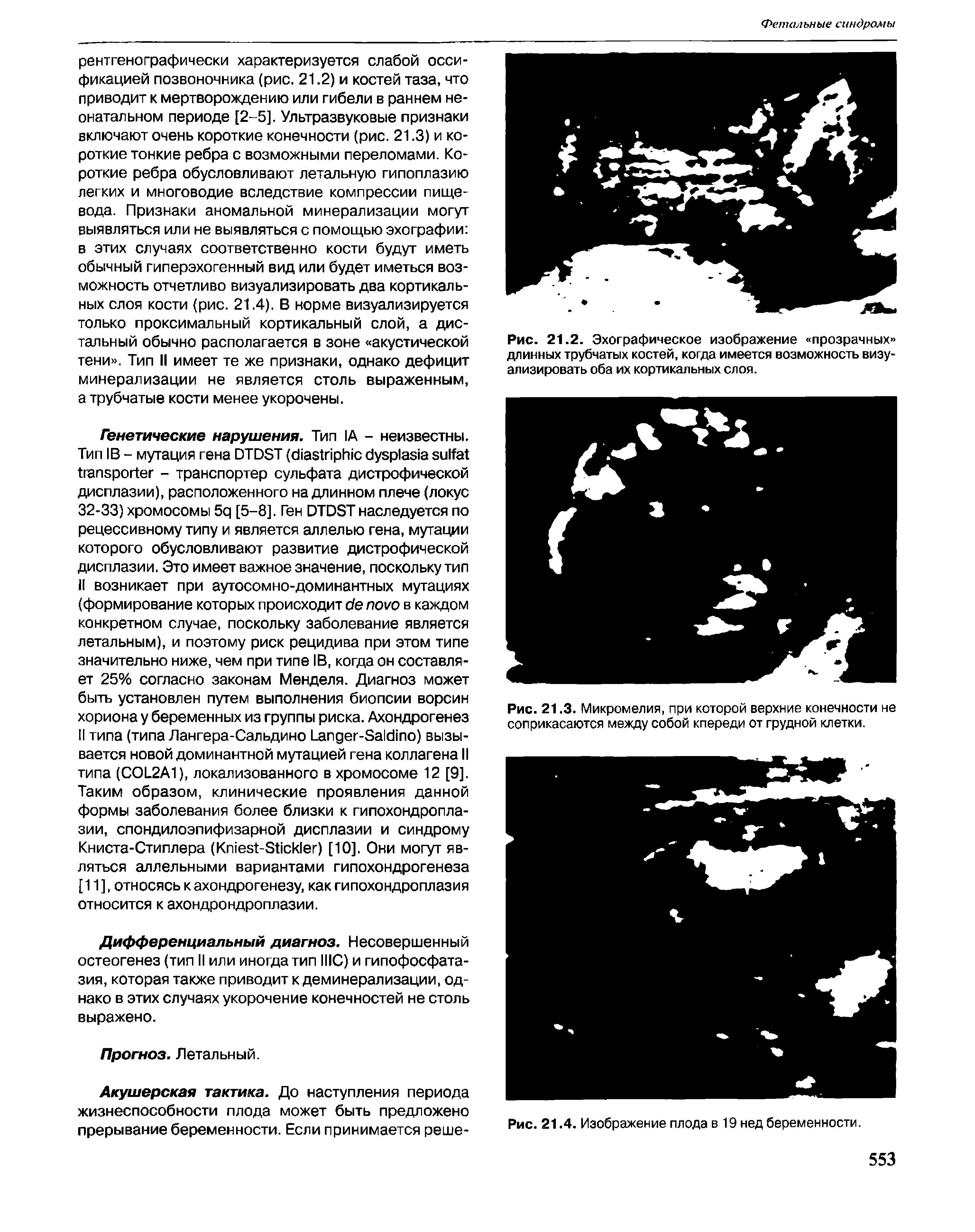 Рис. 21.3. Микромелия, при которой верхние конечности не соприкасаются между собой кпереди от грудной клетки.