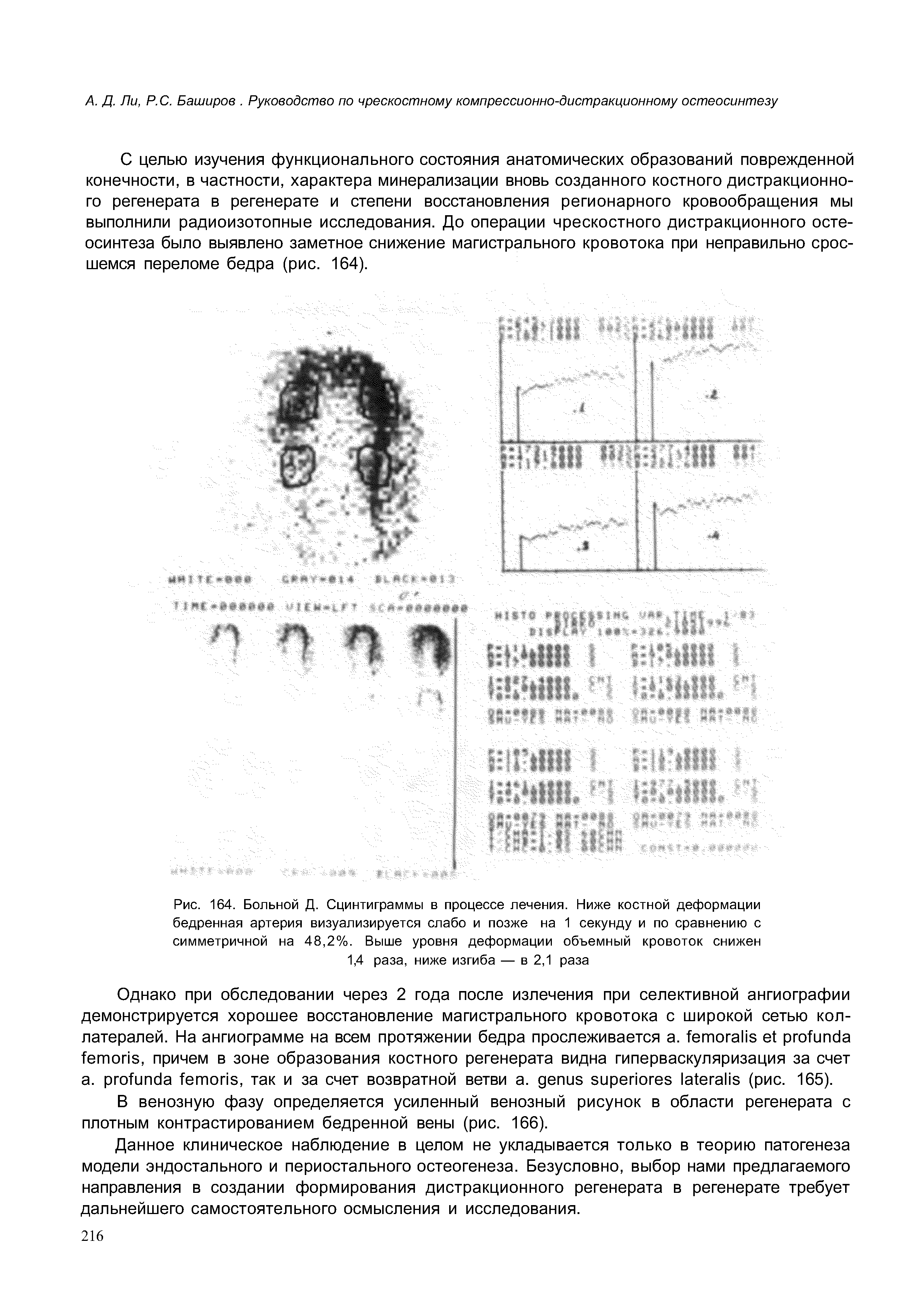 Рис. 164. Больной Д. Сцинтиграммы в процессе лечения. Ниже костной деформации бедренная артерия визуализируется слабо и позже на 1 секунду и по сравнению с симметричной на 48,2%. Выше уровня деформации объемный кровоток снижен 1,4 раза, ниже изгиба — в 2,1 раза...