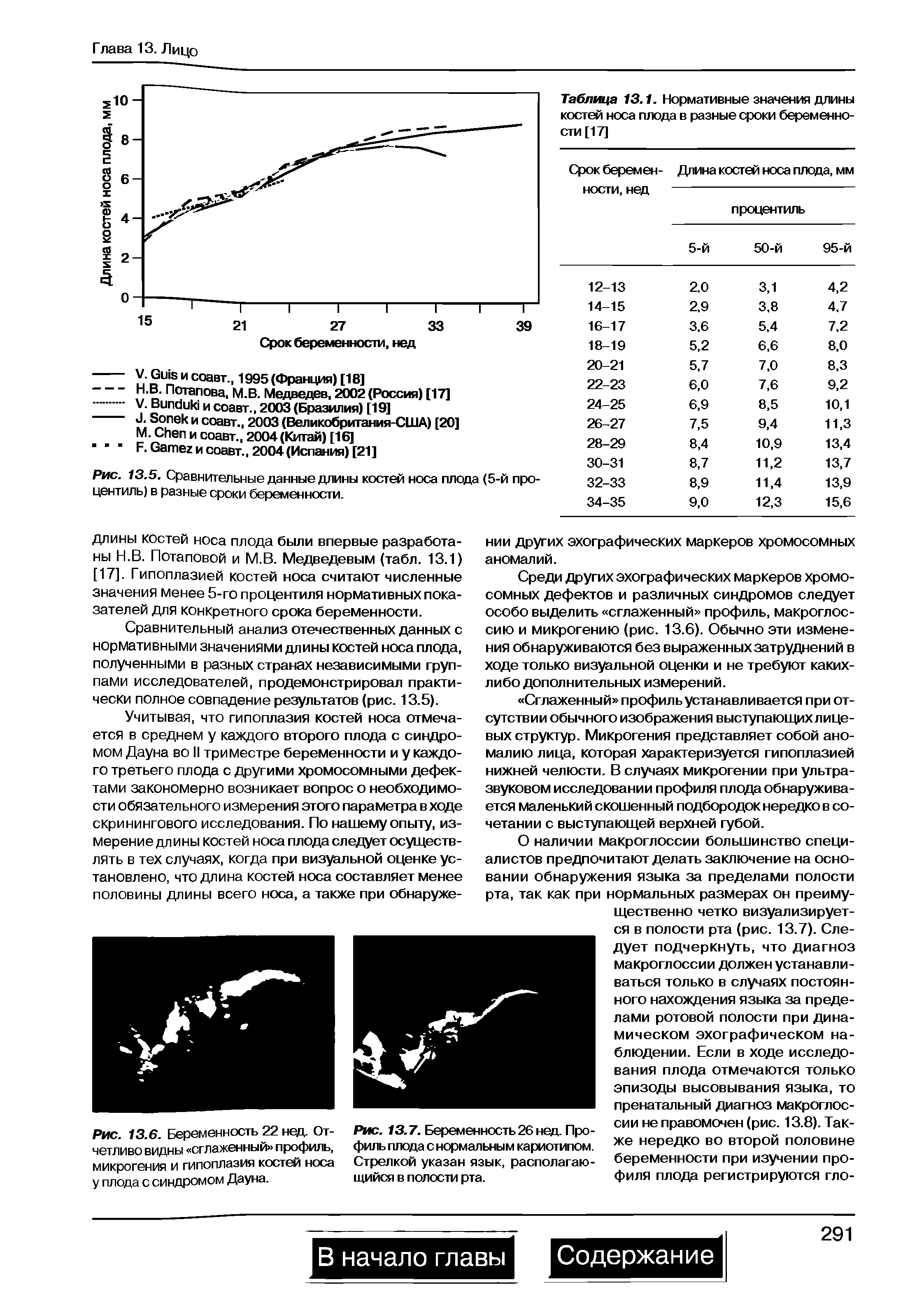 Рис. 13.6. Беременность 22 нед. Отчетливо видны сглаженный профиль, микрогения и гипоплазия костей носа у плода с синдромом Дауна.