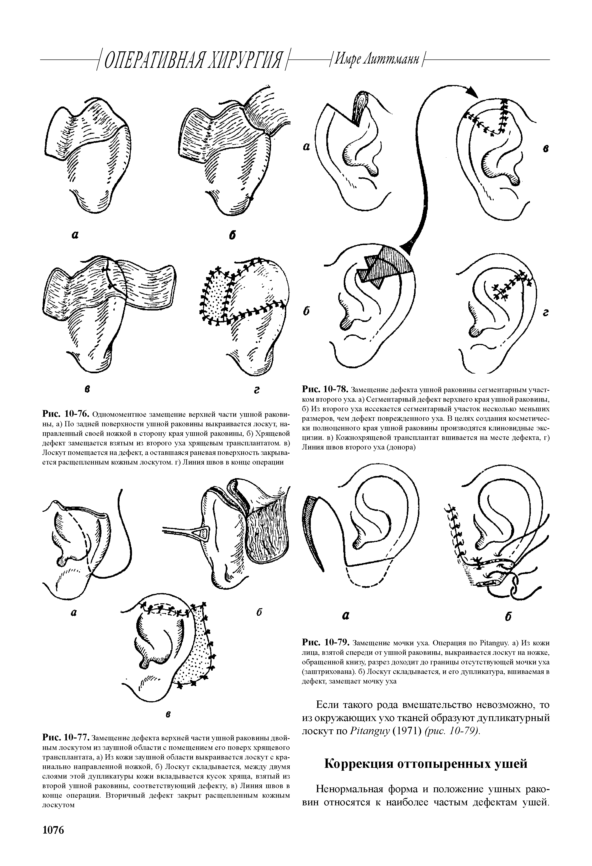 Рис. 10-79. Замещение мочки уха. Операция по Рйаг иу. а) Из кожи лица, взятой спереди от ушной раковины, выкраивается лоскут на ножке, обращенной книзу, разрез доходит до границы отсутствующей мочки уха (заштрихована), б) Лоскут складывается, и его дупликатура, вшиваемая в дефект, замещает мочку уха...