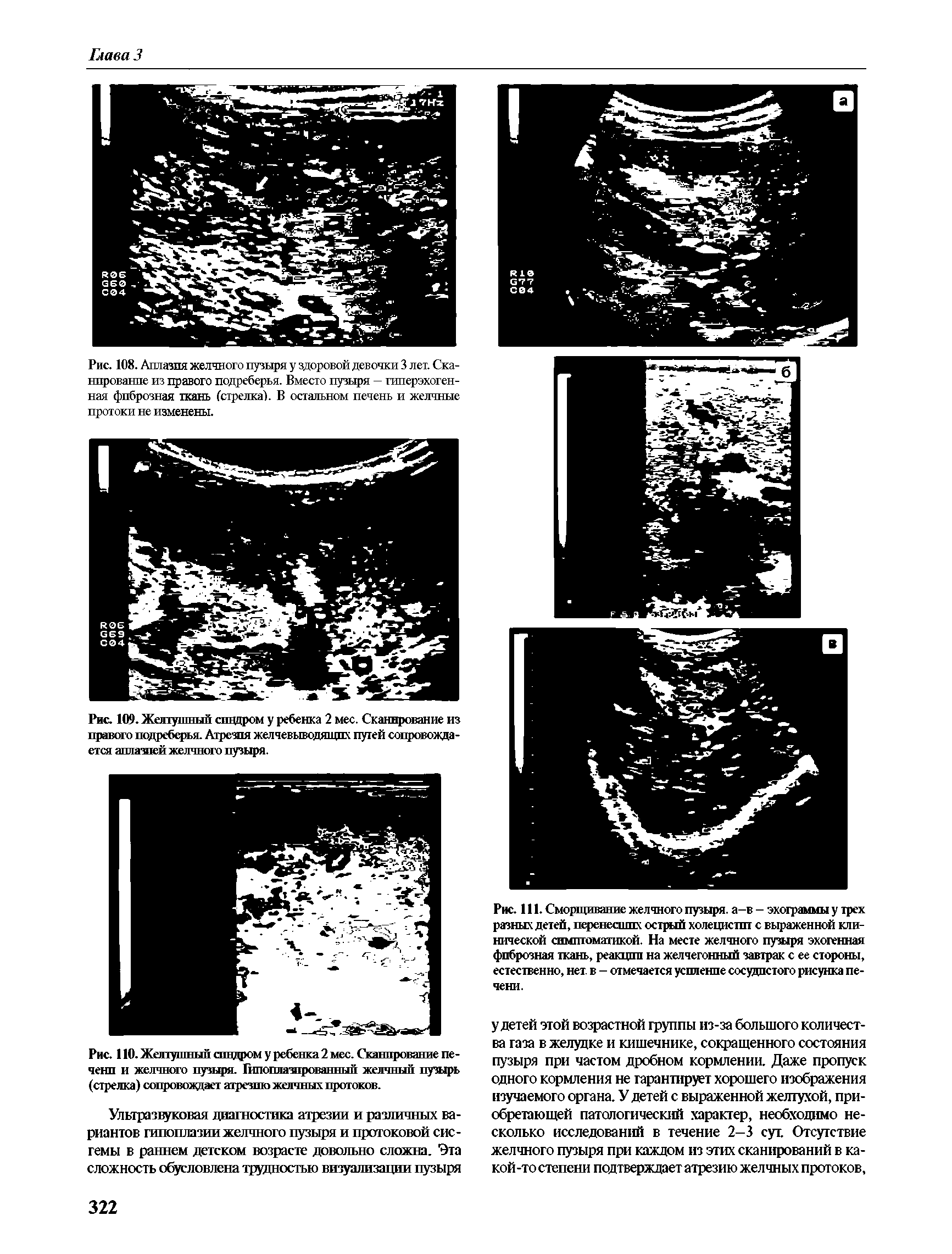 Рис. 110. Желтушный ашдром у ребенка 2 мес. Сканирование печени и желчного пузыря. Гипоплазпрованнып желчный пузырь (стрелка) сопровождает атрезию желчных протоков.