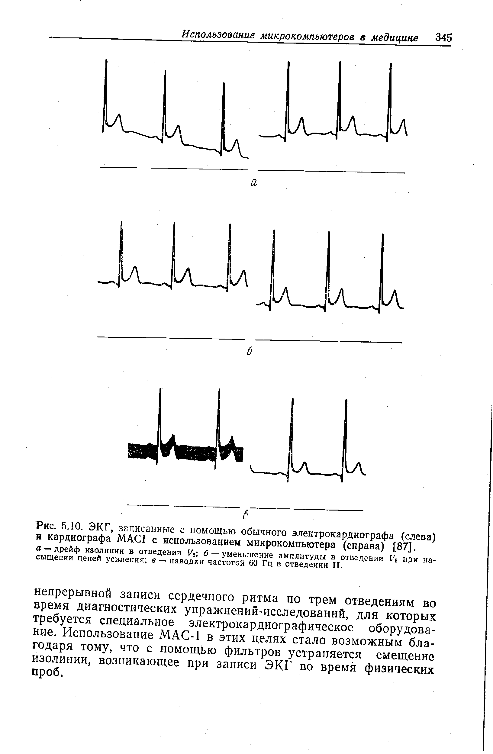 Рис. 5.10. ЭКГ, записанные с помощью обычного электрокардиографа (слева) и кардиографа МАС1 с использованием микрокомпьютера (справа) [87].