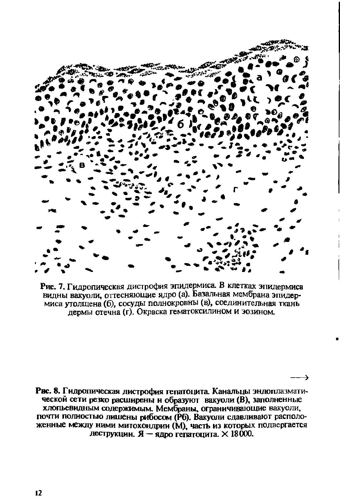 Рис. 7. Гидропическая дистрофия эпидермиса. В клетках эпидермиса видны вакуоли, оттесняющие ядро (а)- Базальная мембрана эпидермиса утолщена (6), сосуды полнокровны (в), соединительная ткань дермы отечна (г). Окраска гематоксилином и эозином.