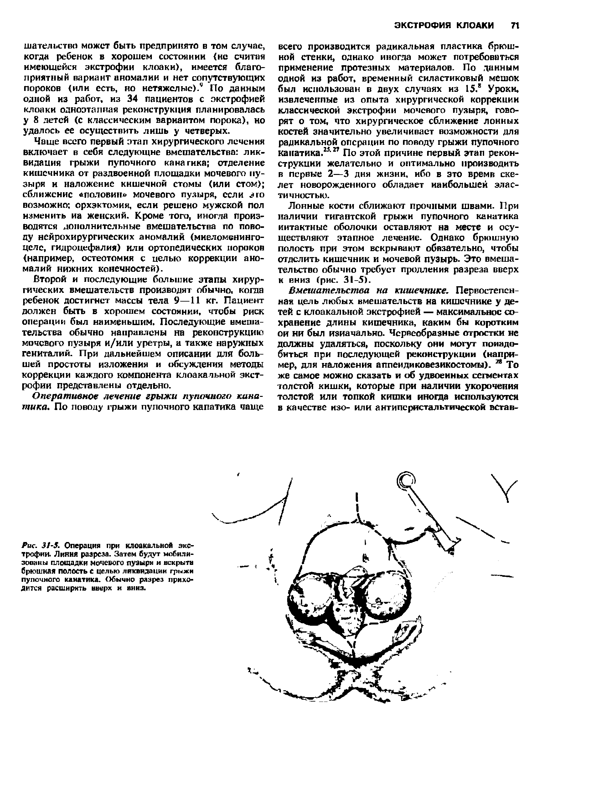 Рис. 31-5. Операция при клоакальной экстрофии. Ливия разреза. Затем будут мобилизованы площадки моченого пузыря и вскрыта брюшная полость с целью ликвидации грыжи пупочного канатика. Обычно разрез приходится расширять вверх и вниз.