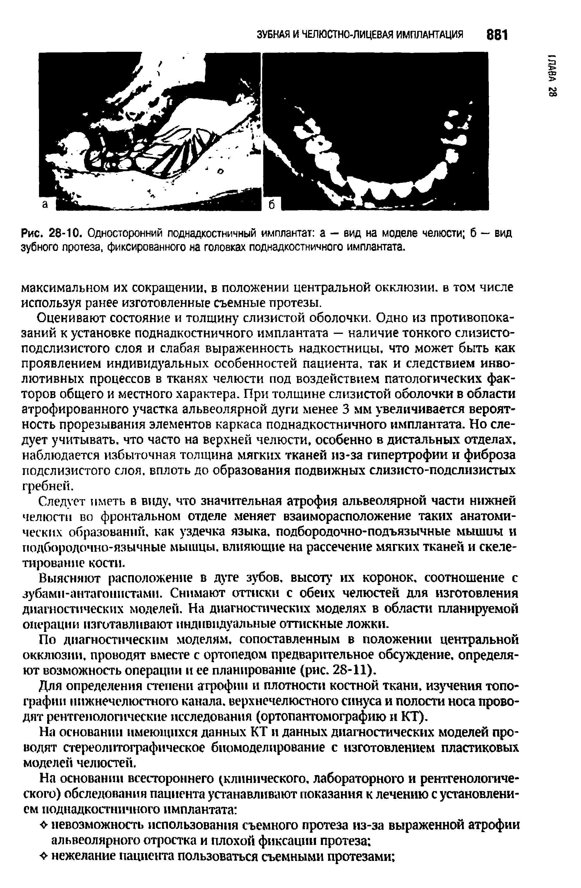 Рис. 28-10. Односторонний поднадкостничный имплантат а — вид на моделе челюсти б — вид зубного протеза, фиксированного на головках поднадкостничного имплантата.