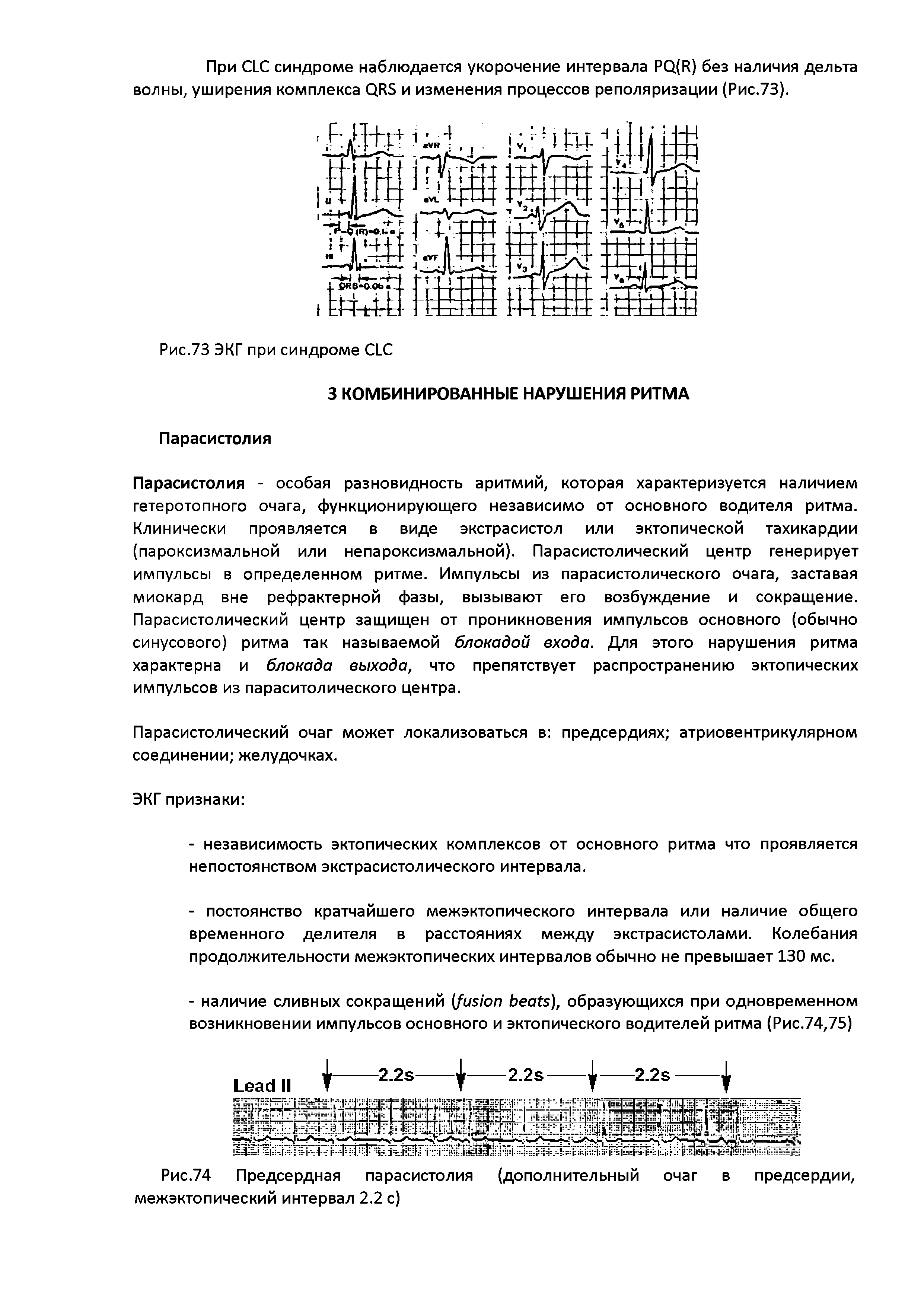 Рис.74 Предсердная парасистолия (дополнительный очаг в предсердии, межэктопический интервал 2.2 с)...