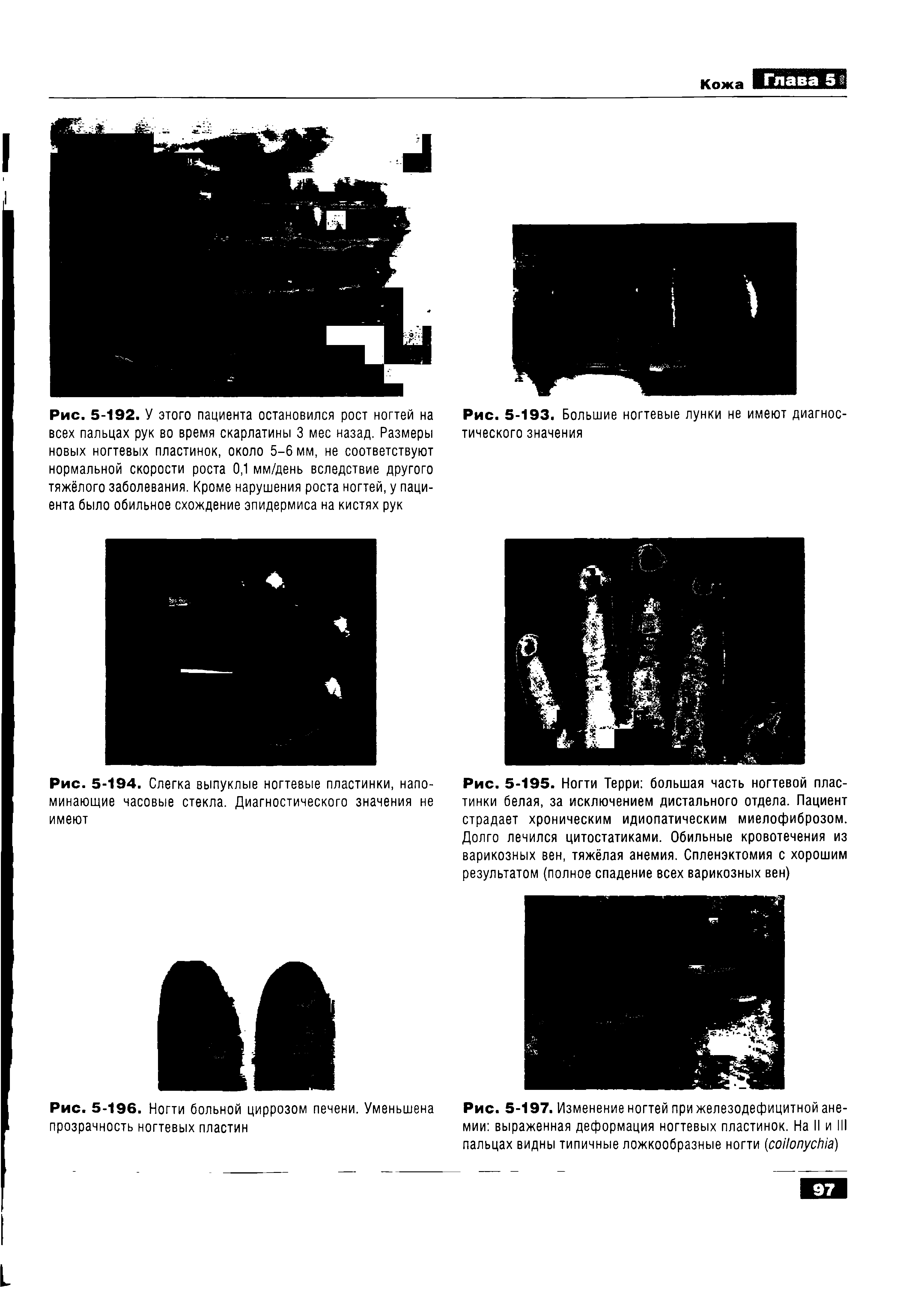 Рис. 5-197. Изменение ногтей при железодефицитной анемии выраженная деформация ногтевых пластинок. На II и III пальцах видны типичные ложкообразные ногти ( )...