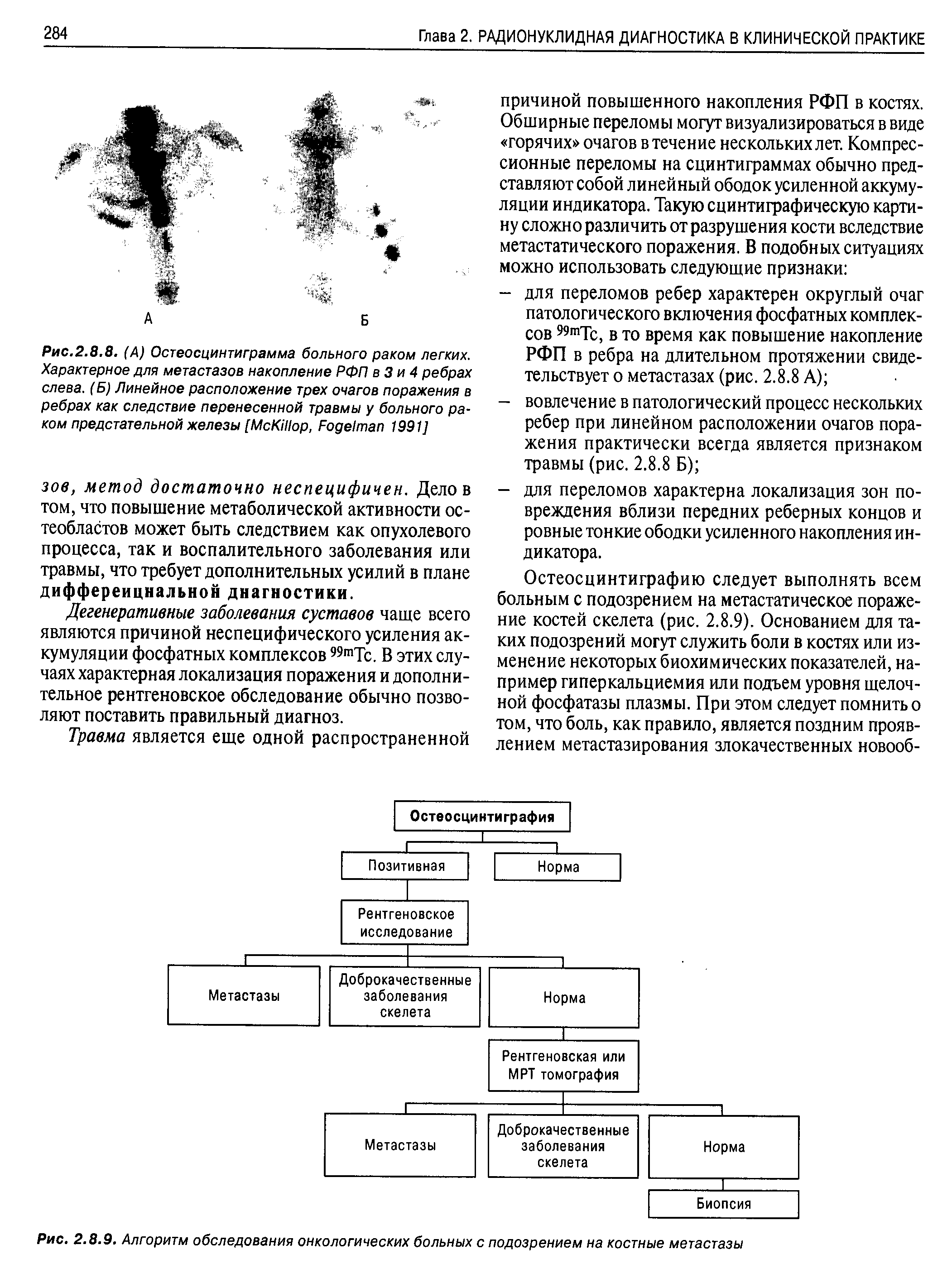 Рис.2.8.8. (А) Остеосцинтиграмма больного раком легких. Характерное для метастазов накопление РФП в 3 и 4 ребрах слева. (Б) Линейное расположение трех очагов поражения в ребрах как следствие перенесенной травмы у больного раком предстательной железы [МсКИ/ор, F 1991]...