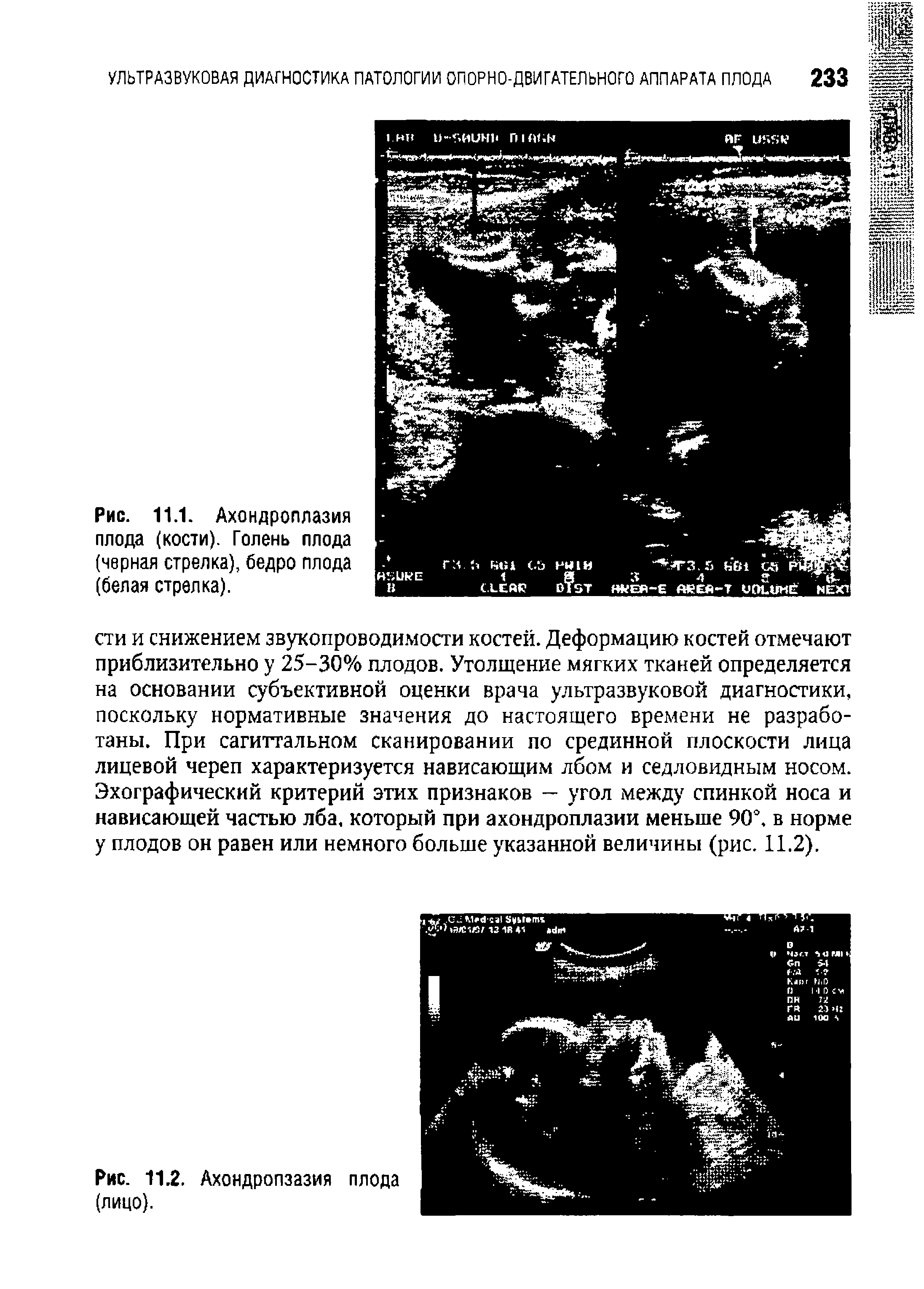 Рис. 11.1. Ахондроплазия плода (кости). Голень плода (черная стрелка), бедро плода (белая стрелка).