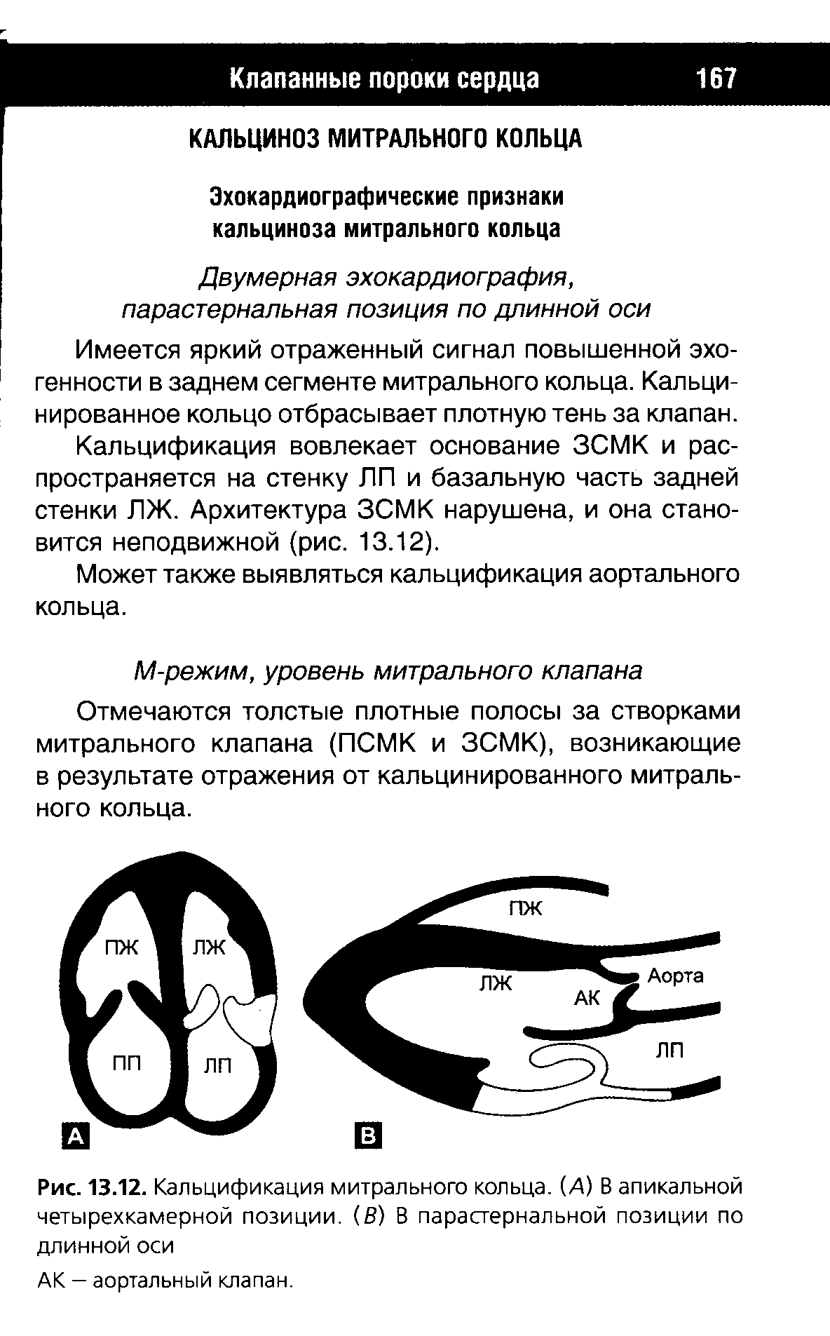 Рис. 13.12. Кальцификация митрального кольца. (А) В апикальной четырехкамерной позиции. (В) В парастернальной позиции по длинной оси...