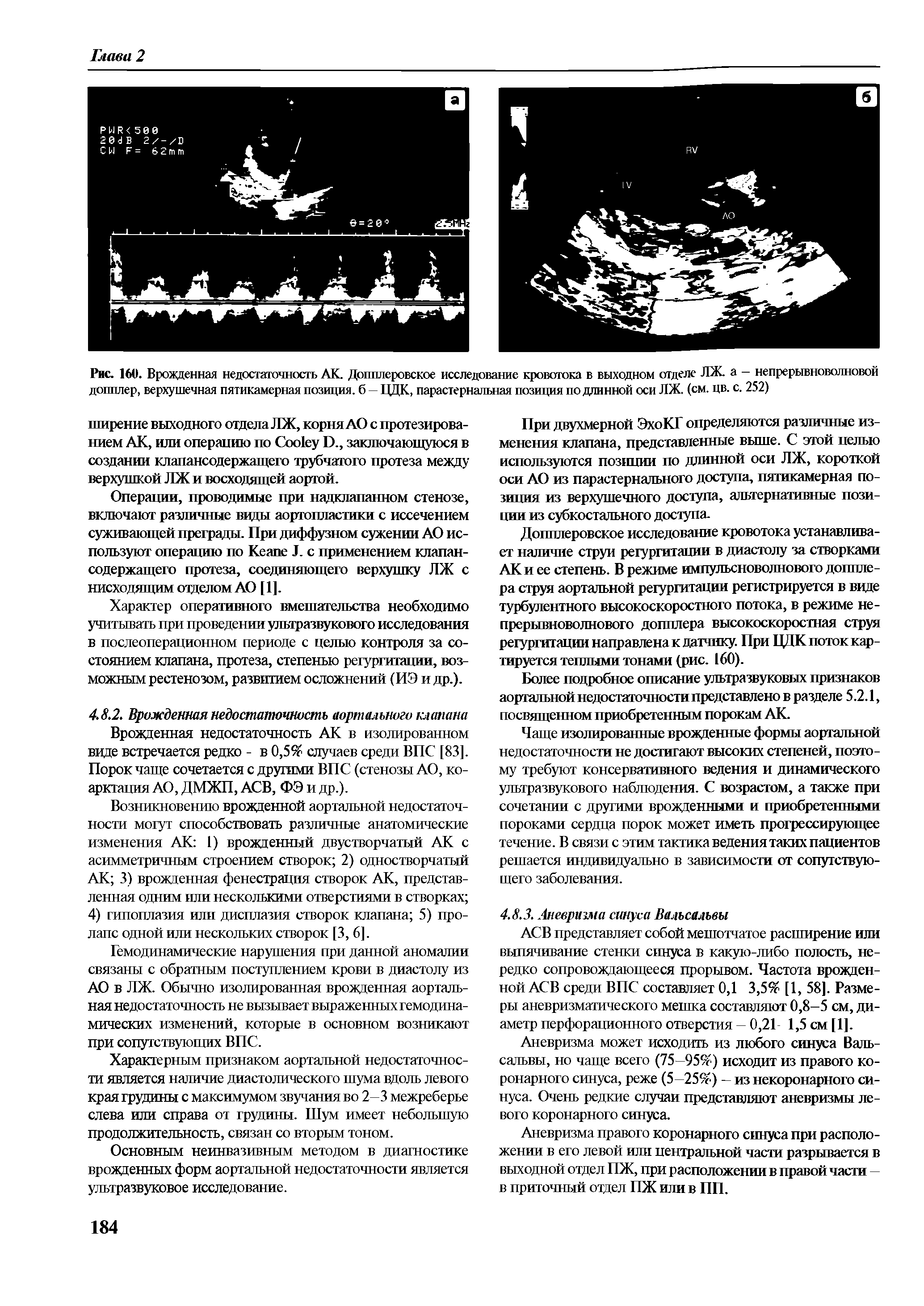 Рис. 160. Врожденная недостаточность АК. Допплеровское исследование кровотока в выходном отделе ЛЖ. а — непрерывноволновой допплер, верхушечная пятикамерная позиция, б — ЦДК, парастернальная позиция подлинной оси ЛЖ. (см. цв. с. 252)...