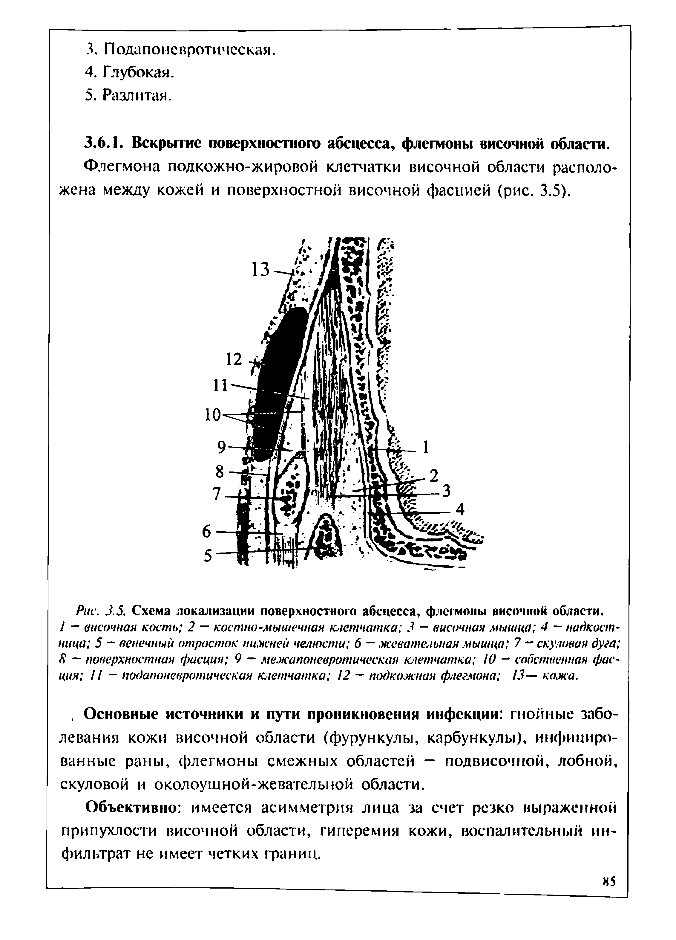 Рис. 3.5. Схема локализации поверхностного абсцесса, флегмоны височной области. / — височная кость 2 — костно-мышечная клетчатка 3 — височная мышца 4 надкостница 5 - венечный отросток нижней челюсти б — жевательная мышца 7 — скуловая дуга <9 — поверхностная фасция 9 — межапоневротическая клетчатка 10 — собственная фасция // - подапоневротическая клетчатка 2 — подкожная флегмона 13— кожа.