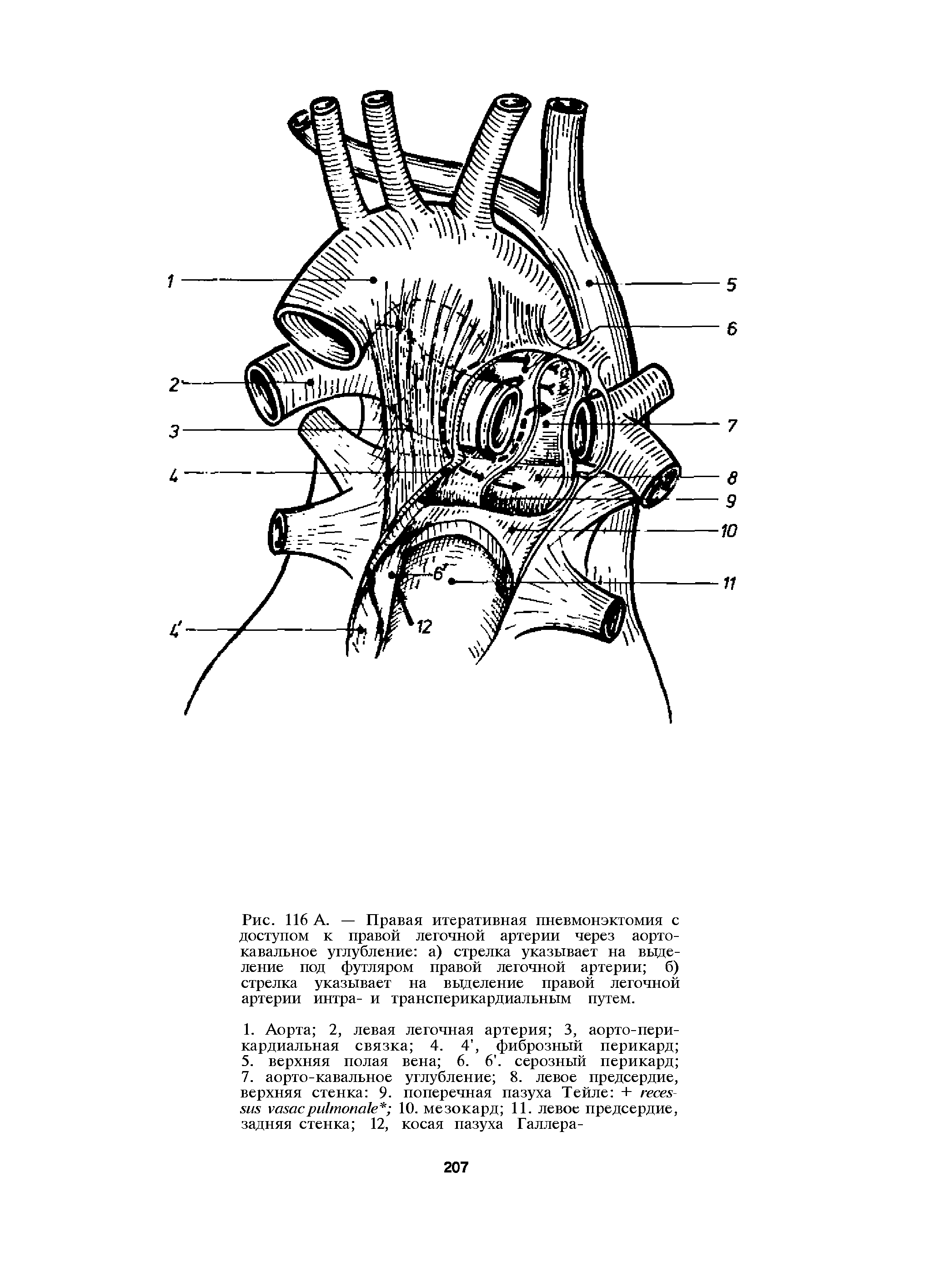 Рис. 116 А. — Правая итеративная пневмонэктомия с доступом к правой легочной артерии через аортокавальное углубление а) стрелка указывает на выделение под футляром правой легочной артерии б) стрелка указывает на выделение правой легочной артерии интра- и трансперикардиальным путем.