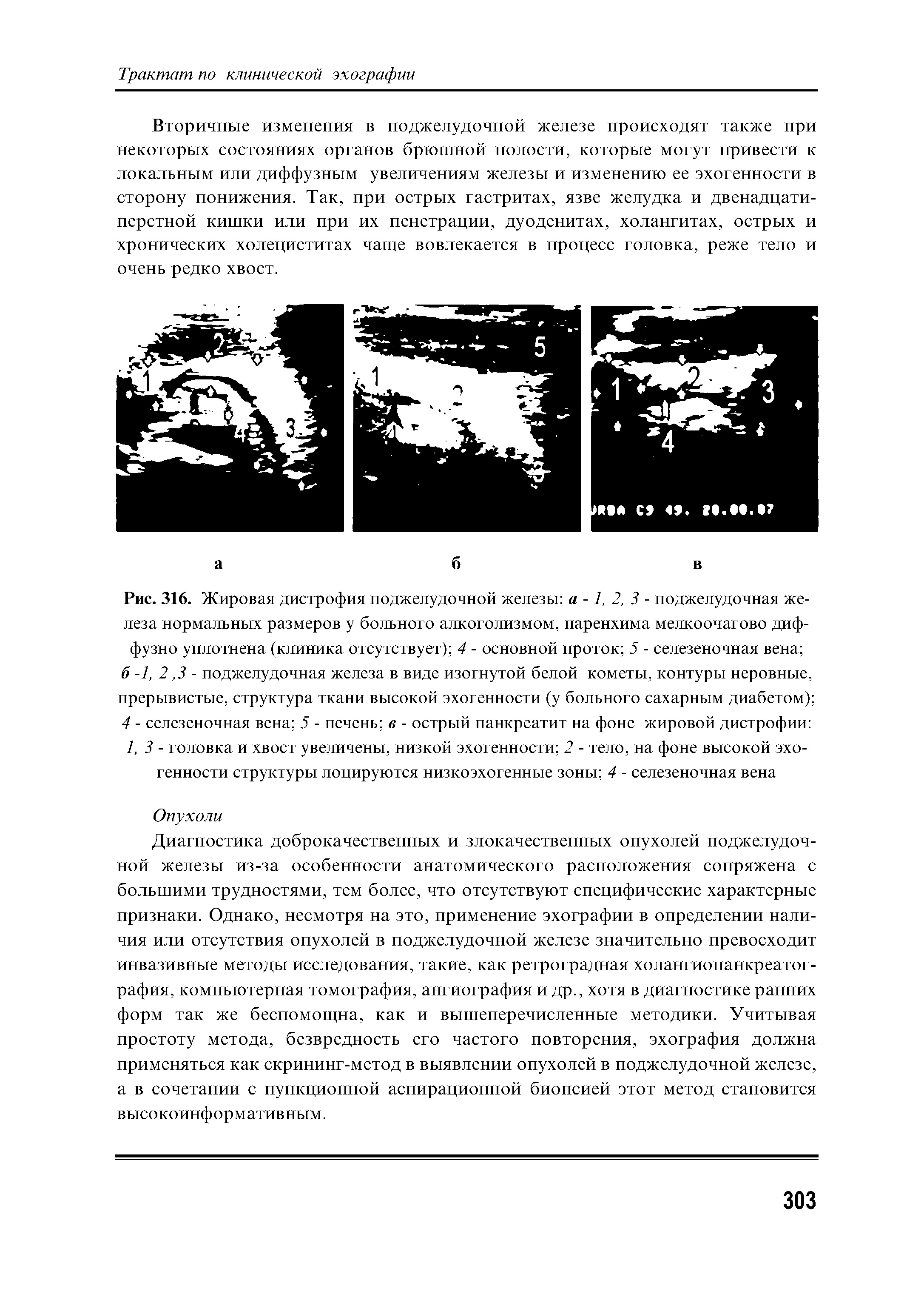 Рис. 316. Жировая дистрофия поджелудочной железы а -1, 2, 3 - поджелудочная железа нормальных размеров у больного алкоголизмом, паренхима мелкоочагово диффузно уплотнена (клиника отсутствует) 4 - основной проток 5 - селезеночная вена ...