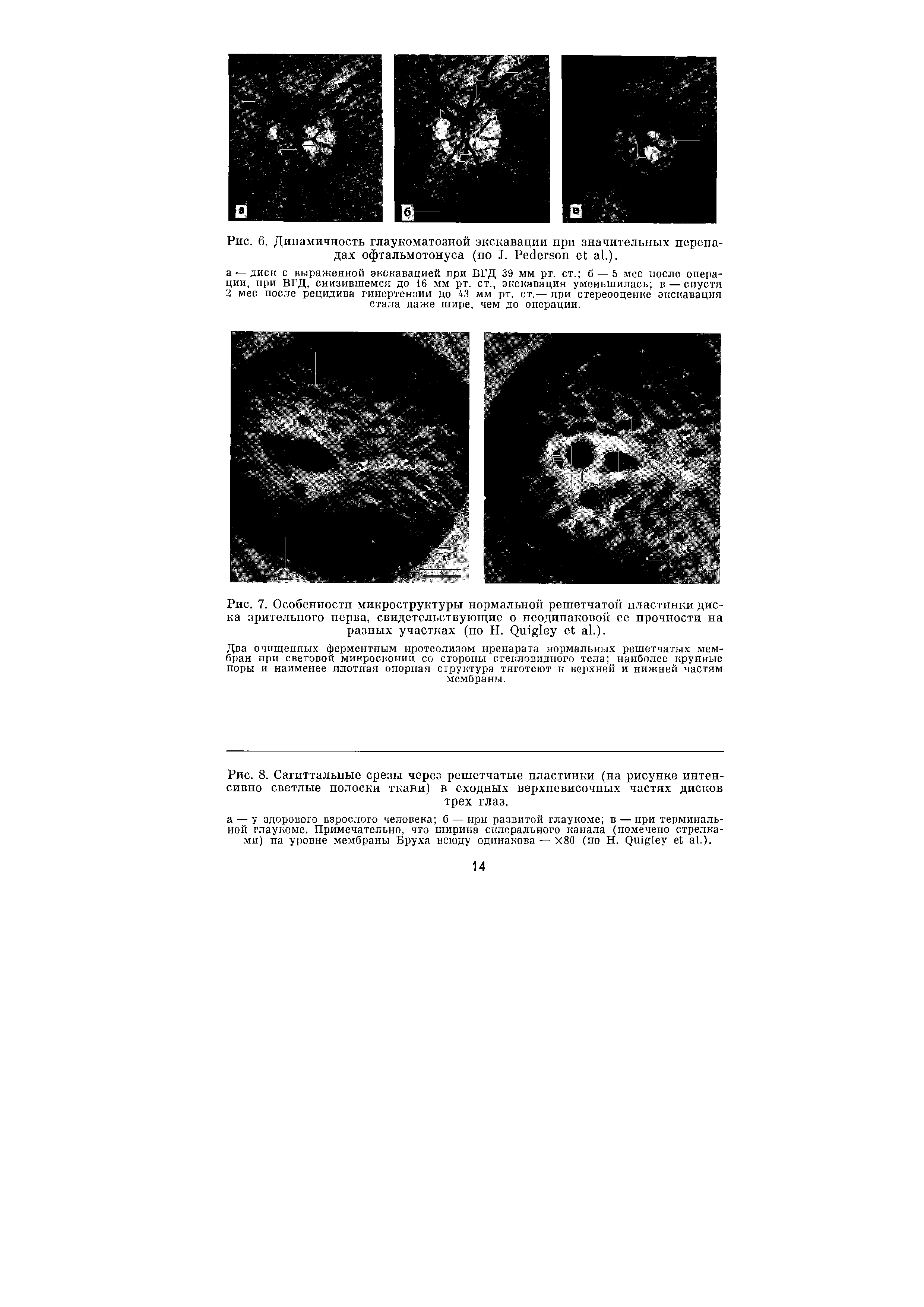 Рис. 8. Сагиттальные срезы через решетчатые пластинки (на рисунке интенсивно светлые полоски ткани) в сходных верхневисочных частях дисков трех глаз.