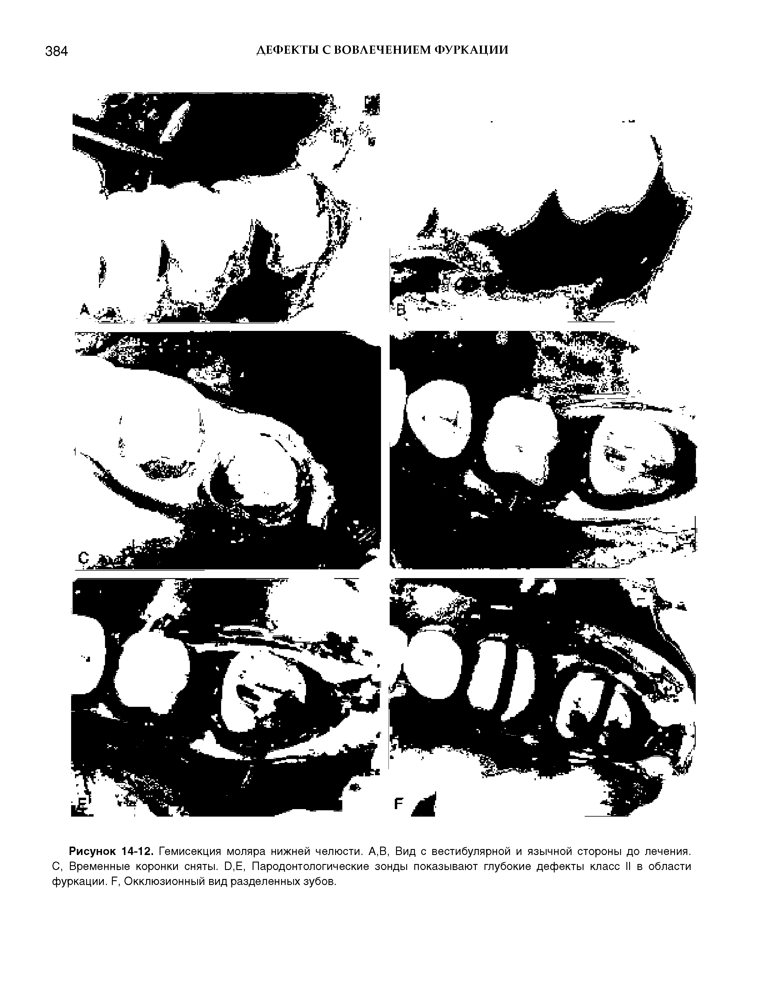 Рисунок 14-12. Гемисекция моляра нижней челюсти. А,В, Вид с вестибулярной и язычной стороны до лечения. С, Временные коронки сняты. 0,Е, Пародонтологические зонды показывают глубокие дефекты класс II в области фуркации. Г, Окклюзионный вид разделенных зубов.