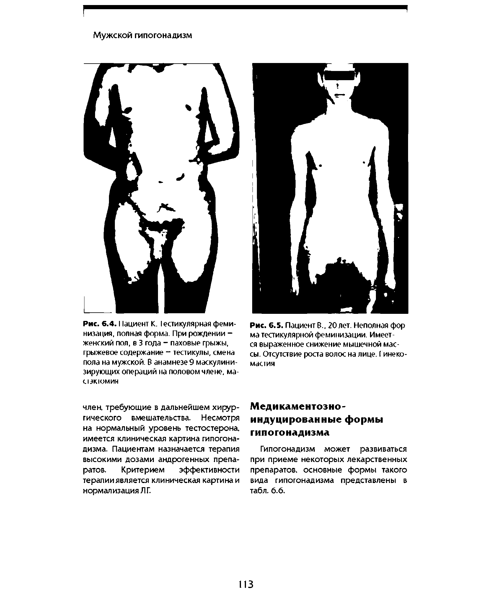 Рис. 6.4.11ациент К. I ретикулярная феминизация, полная форма. При рождении -женский пол, в 3 года - паховые грыжы, грыжевое содержание - тестикулы, смена пола на мужской. В анамнезеЭ маскулинизирующих операций на половом члене, ма-С13К1ОМИЯ...