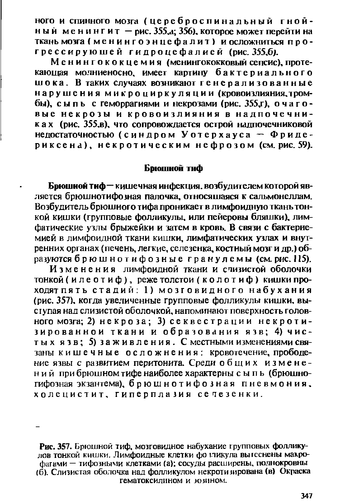 Рис. 357. Брюшной тиф, мозговидное набухание групповых фолликулов тонкой кишки. Лимфоидные клетки фо пикула выгсснены макрофагами — тифозными клетками (а) сосуды расширены, полнокровны (б). Слизистая оболочка над фолликулом некротизирована (в) Окраска гематоксилином и эозином.