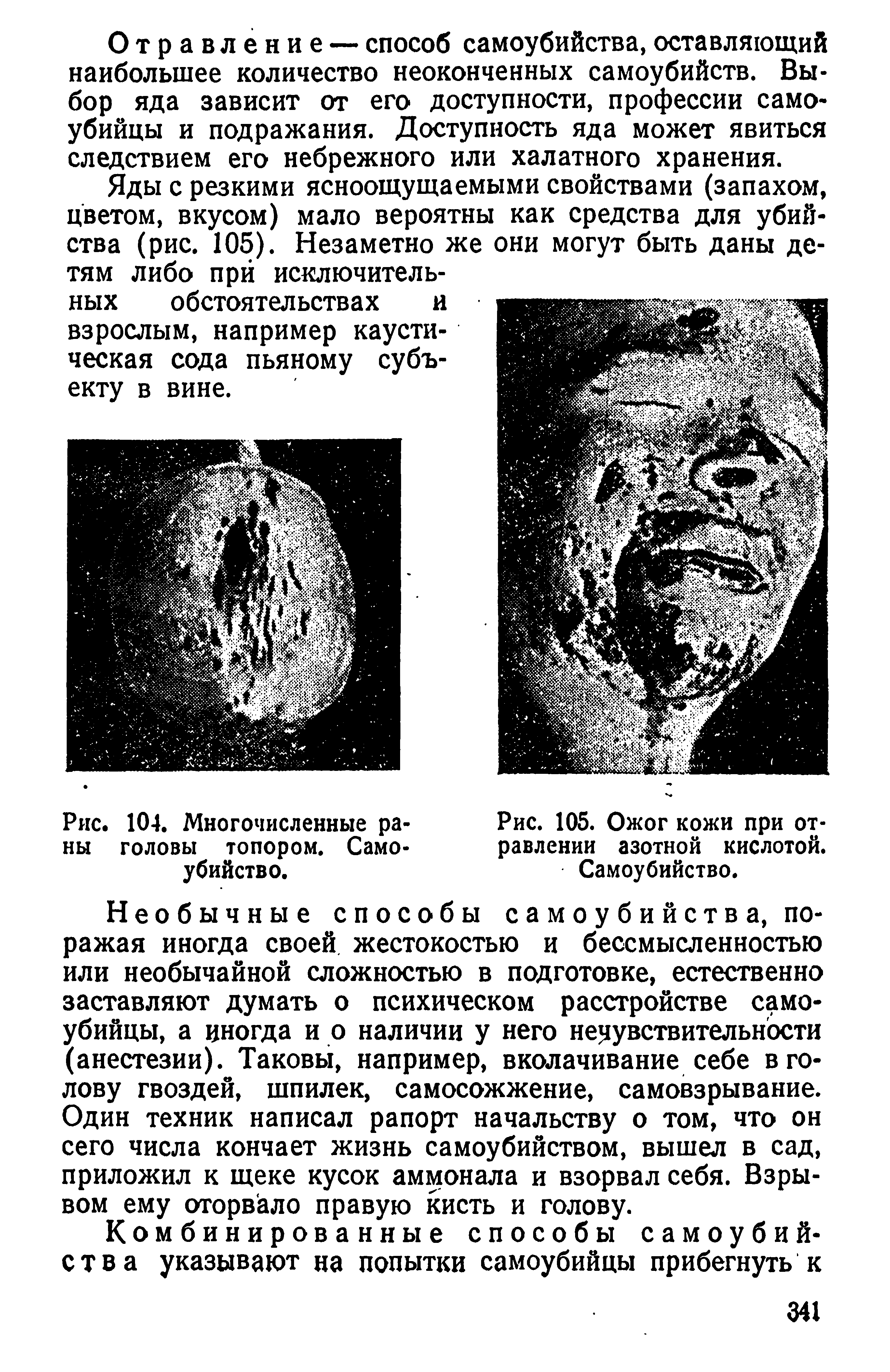 Рис. 105. Ожог кожи при отравлении азотной кислотой. Самоубийство.