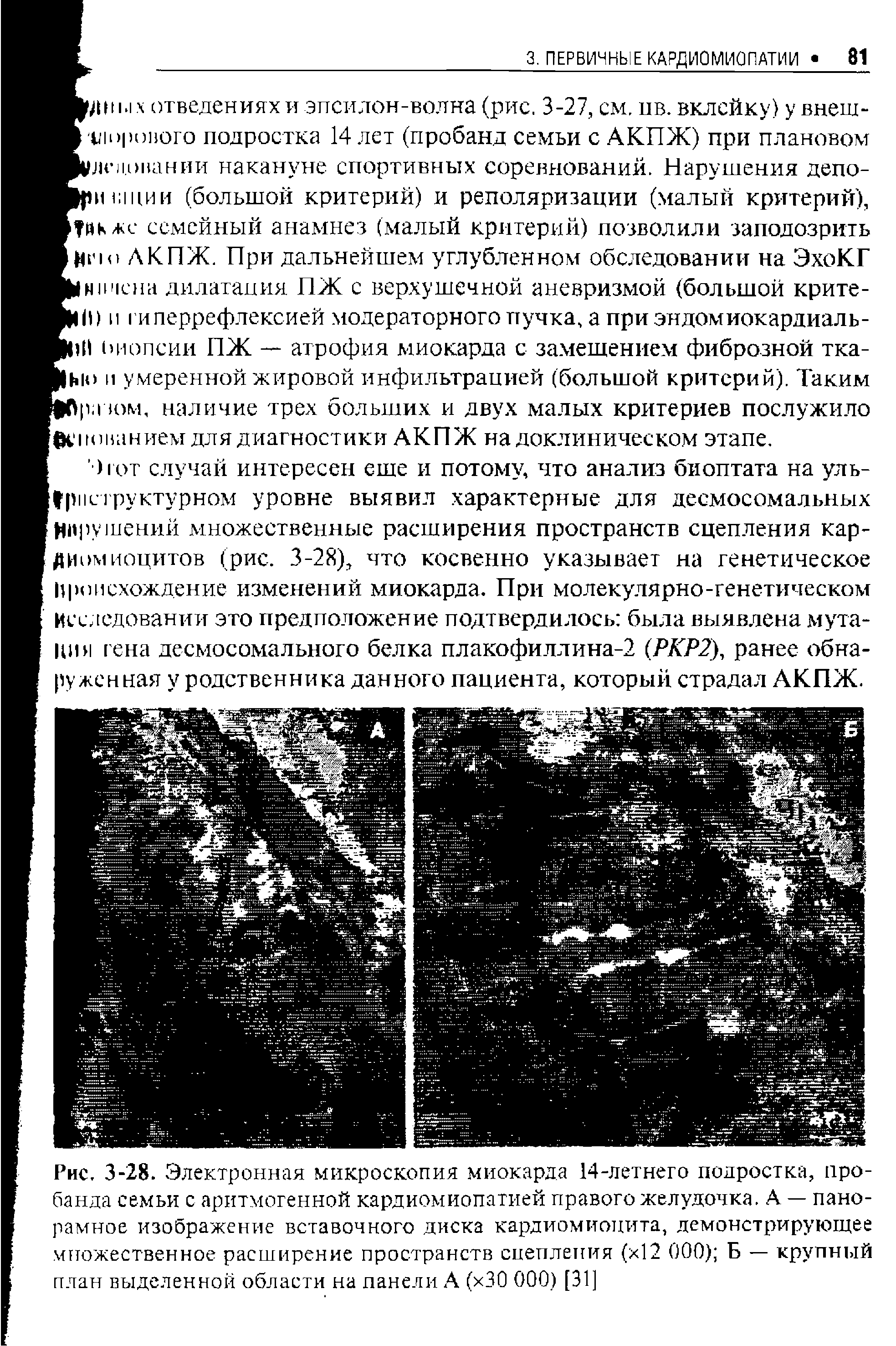 Рис. 3-28. Электронная микроскопия миокарда 14-летнего подростка, пробанда семьи с аритмогенной кардиомиопатией правого желудочка. А — панорамное изображение вставочного диска кардиомиоцита, демонстрирующее множественное расширение пространств сцепления (х12 ООО) Б — крупный план выделенной области на панели А (хЗО ООО) [31]...