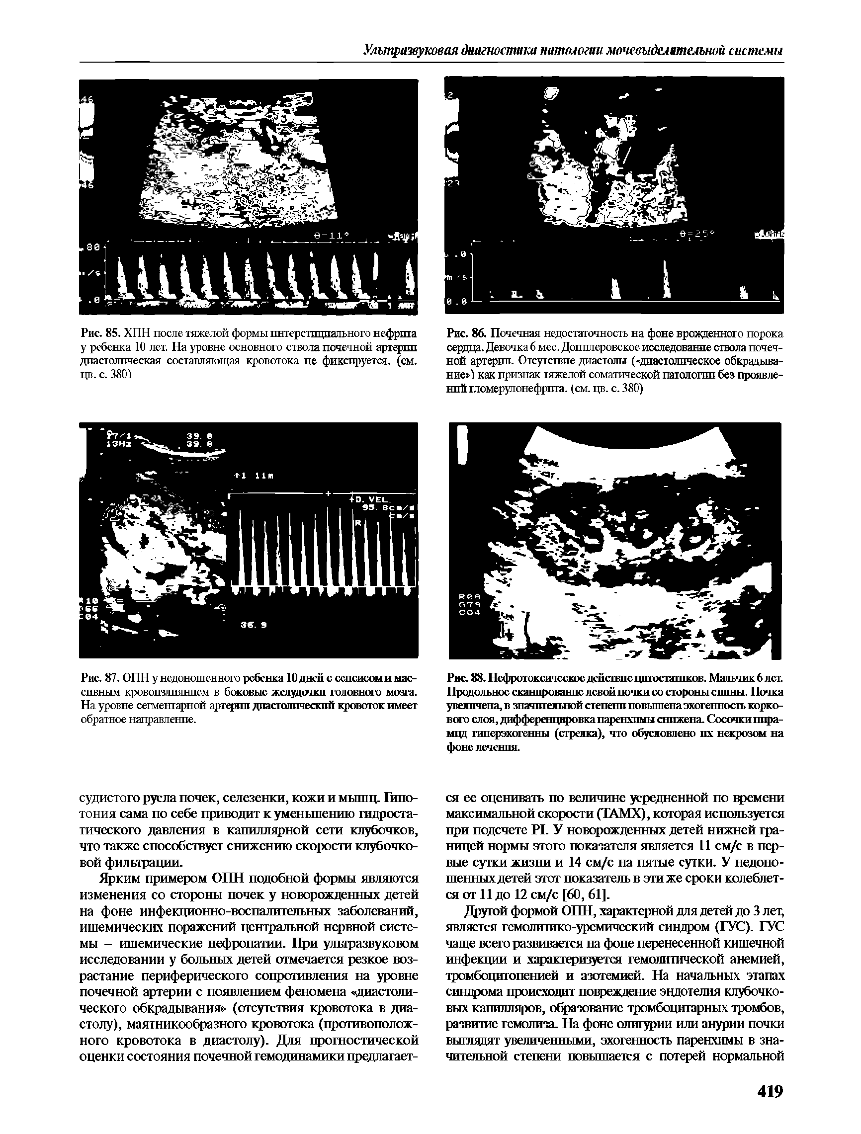 Рис. 87. ОПН у недоношенного ребенка 10 дней с сепсисоми массивным кровоизлиянием в боковые желудочки головного мозга. На уровне сегментарной артерпп дпастолпчежпй кровоток имеет обратное направление.