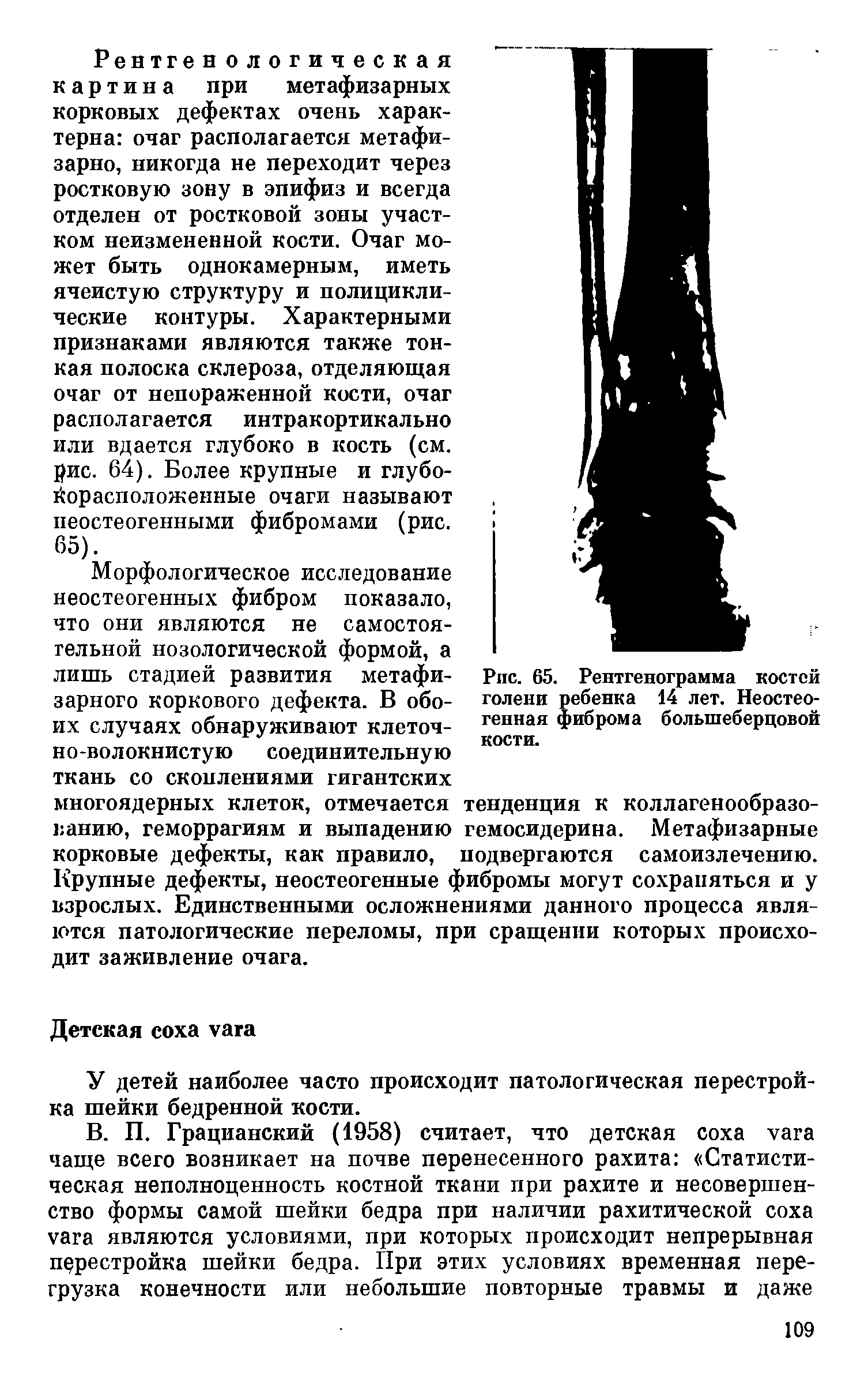 Рис. 65. Рентгенограмма костей голени ребенка 14 лет. Неостеогенная фиброма большеберцовой кости.