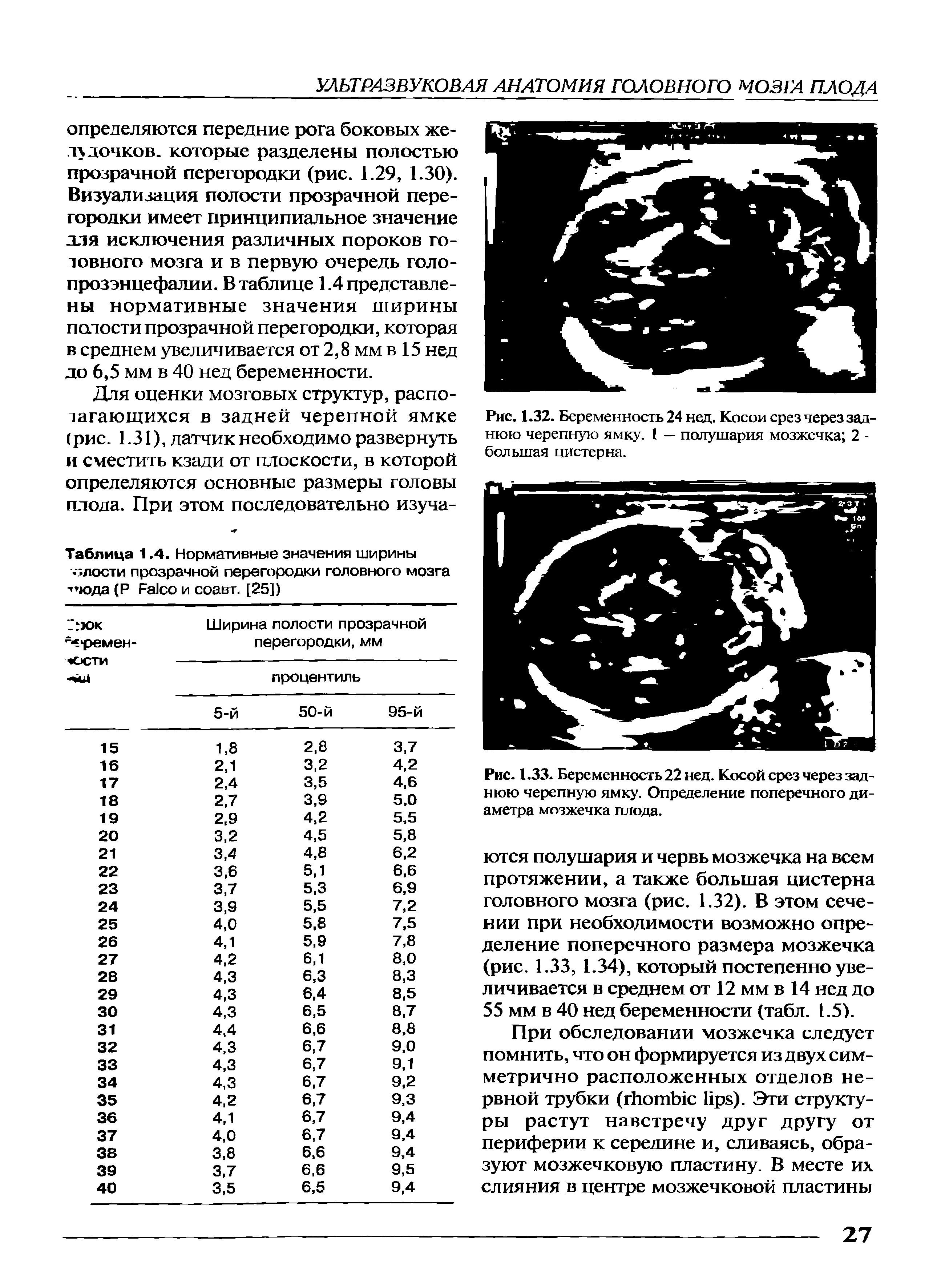 Рис. 1.32. Беременность 24 нед. Косой срез через заднюю черепную ямку. I — полушария мозжечка 2 -большая цистерна.