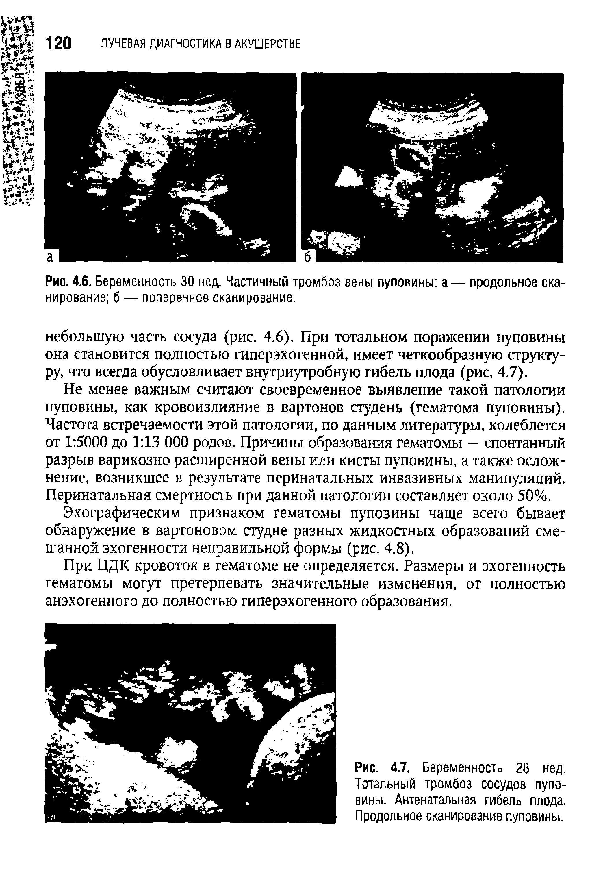 Рис. 4.7. Беременность 28 нед. Тотальный тромбоз сосудов пуповины. Антенатальная гибель плода. Продольное сканирование пуповины.