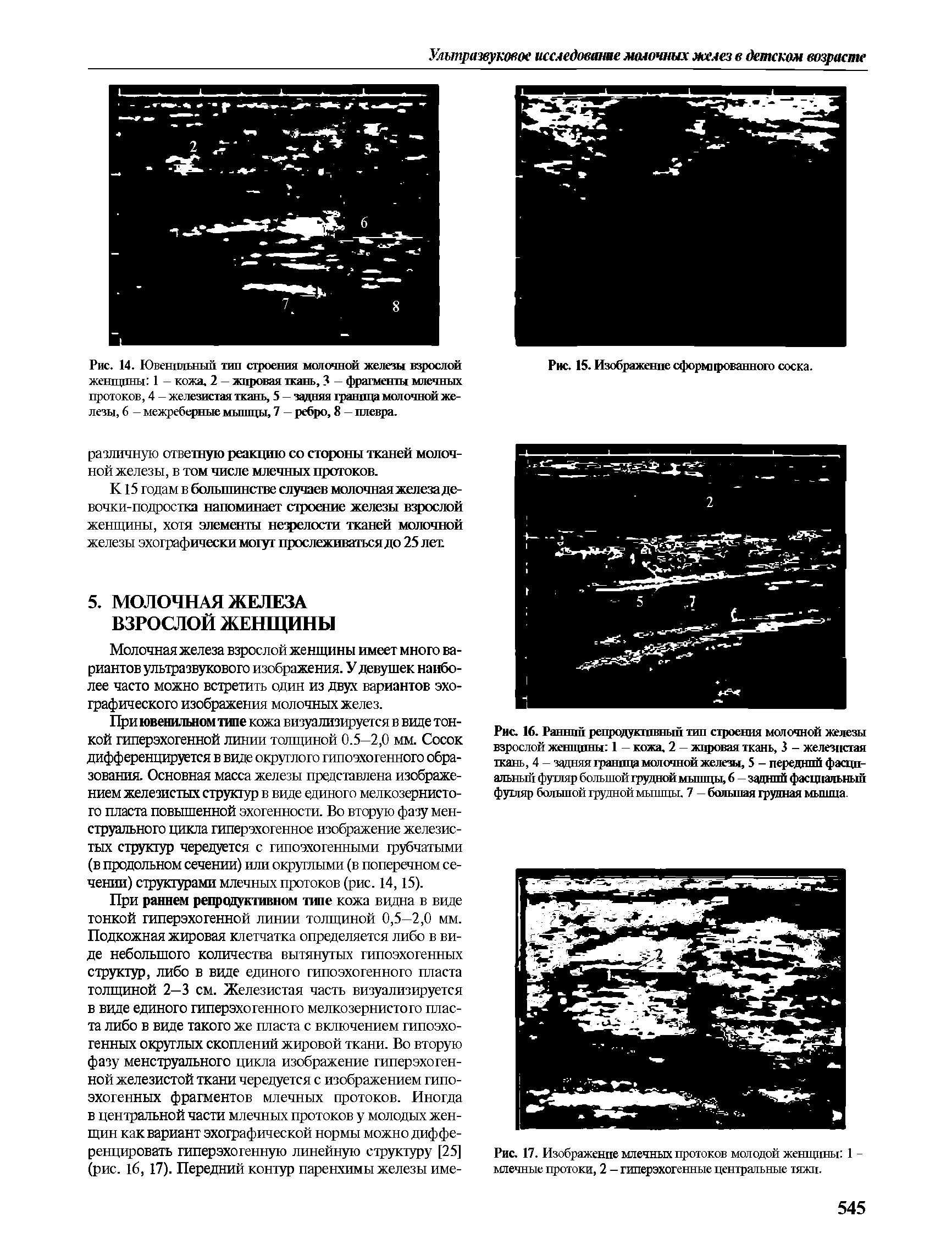 Рис. 14. Ювенильный тип строения молочной железы взрослой женщины 1 - кожа, 2 — жировая ткань, 3 — фрагменты млечных протоков, 4 - железистая ткань, 5 — задняя граница молочной железы, 6 - межреберные мышцы, 7 — ребро, 8 — плевра.