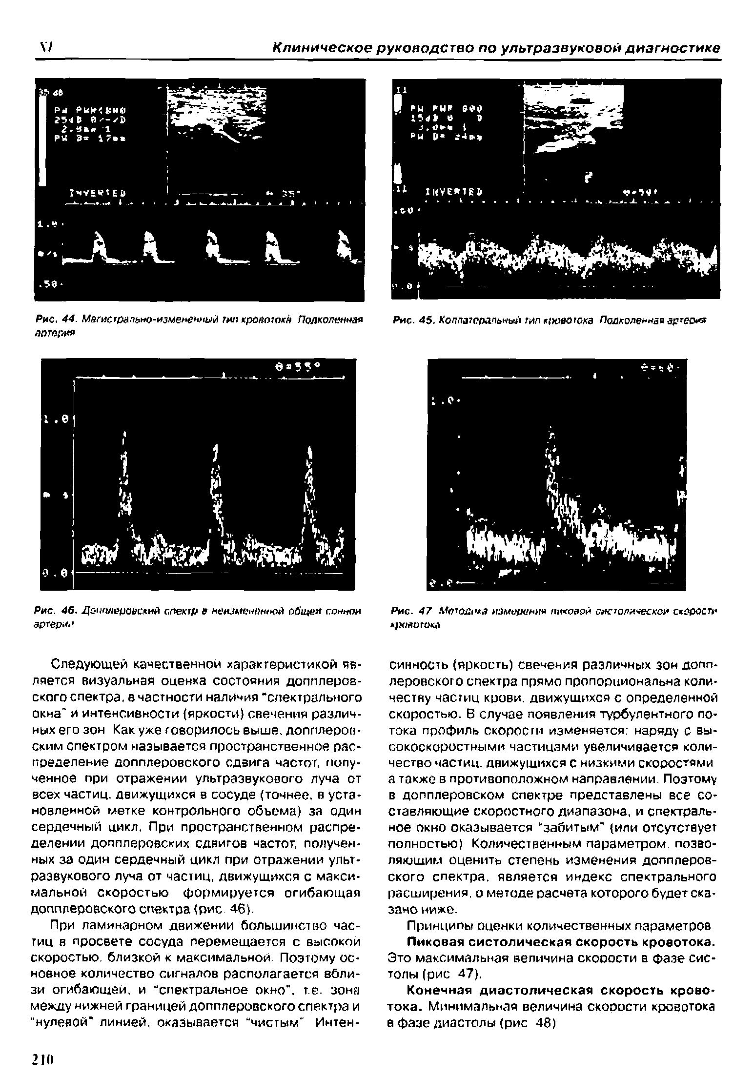 Рис. 46. Дочл/юровсхий спектр в неизмененной общем сонном артерии...