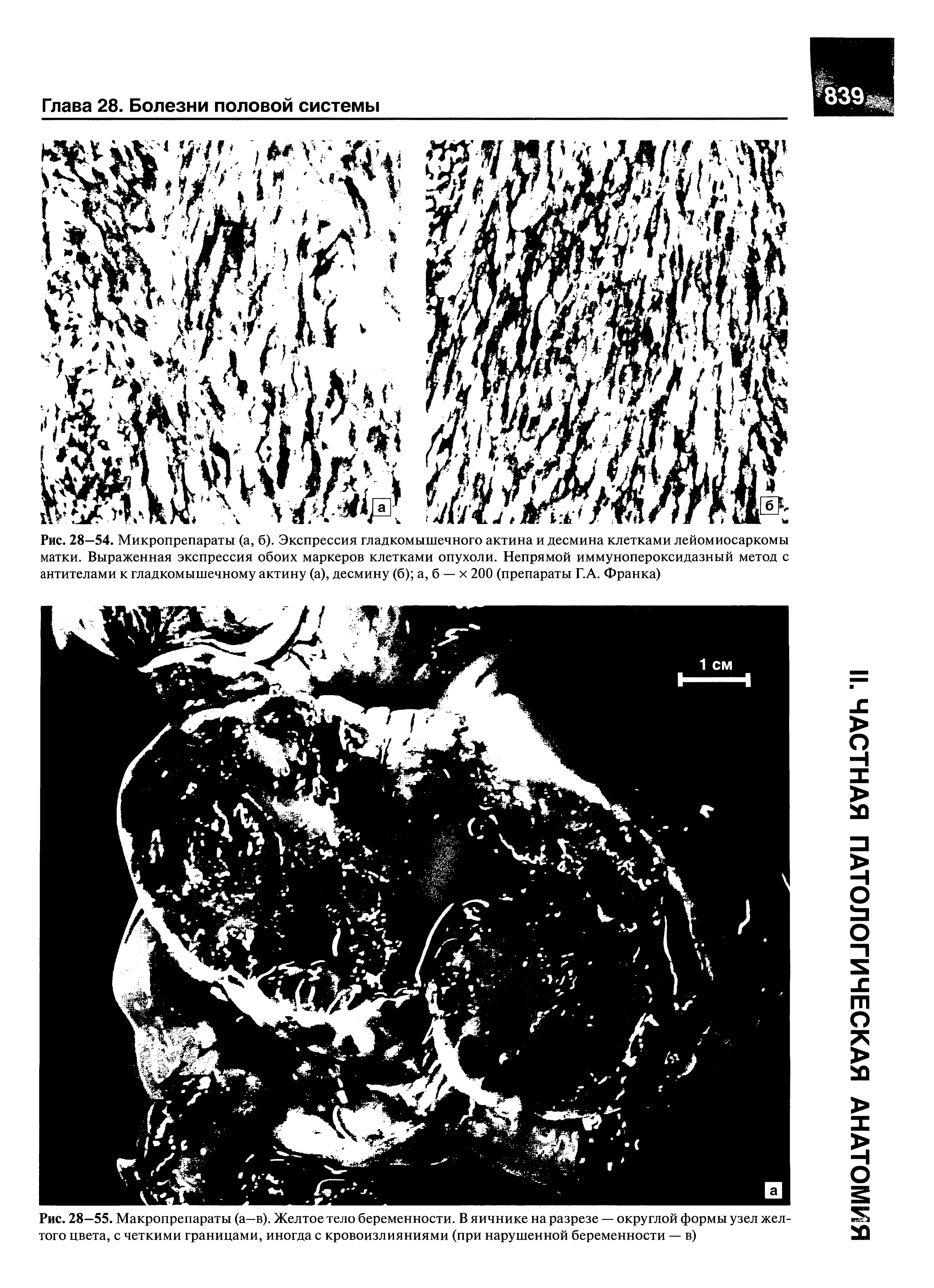 Рис. 28—54. Микропрепараты (а, б). Экспрессия гладкомышечного актина и десмина клетками лейомиосаркомы матки. Выраженная экспрессия обоих маркеров клетками опухоли. Непрямой иммунопероксидазный метод с антителами к гладкомышечному актину (а), десмину (б) а, б — х 200 (препараты Г.А. Франка)...