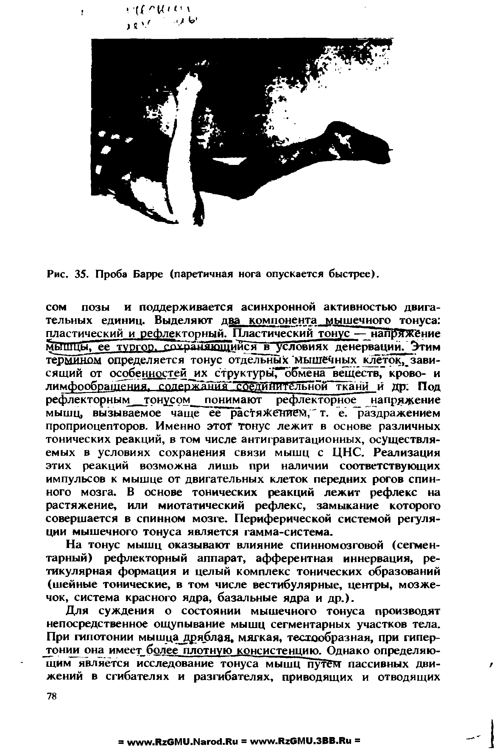 Рис. 35. Проба Барре (паретичная нога опускается быстрее).