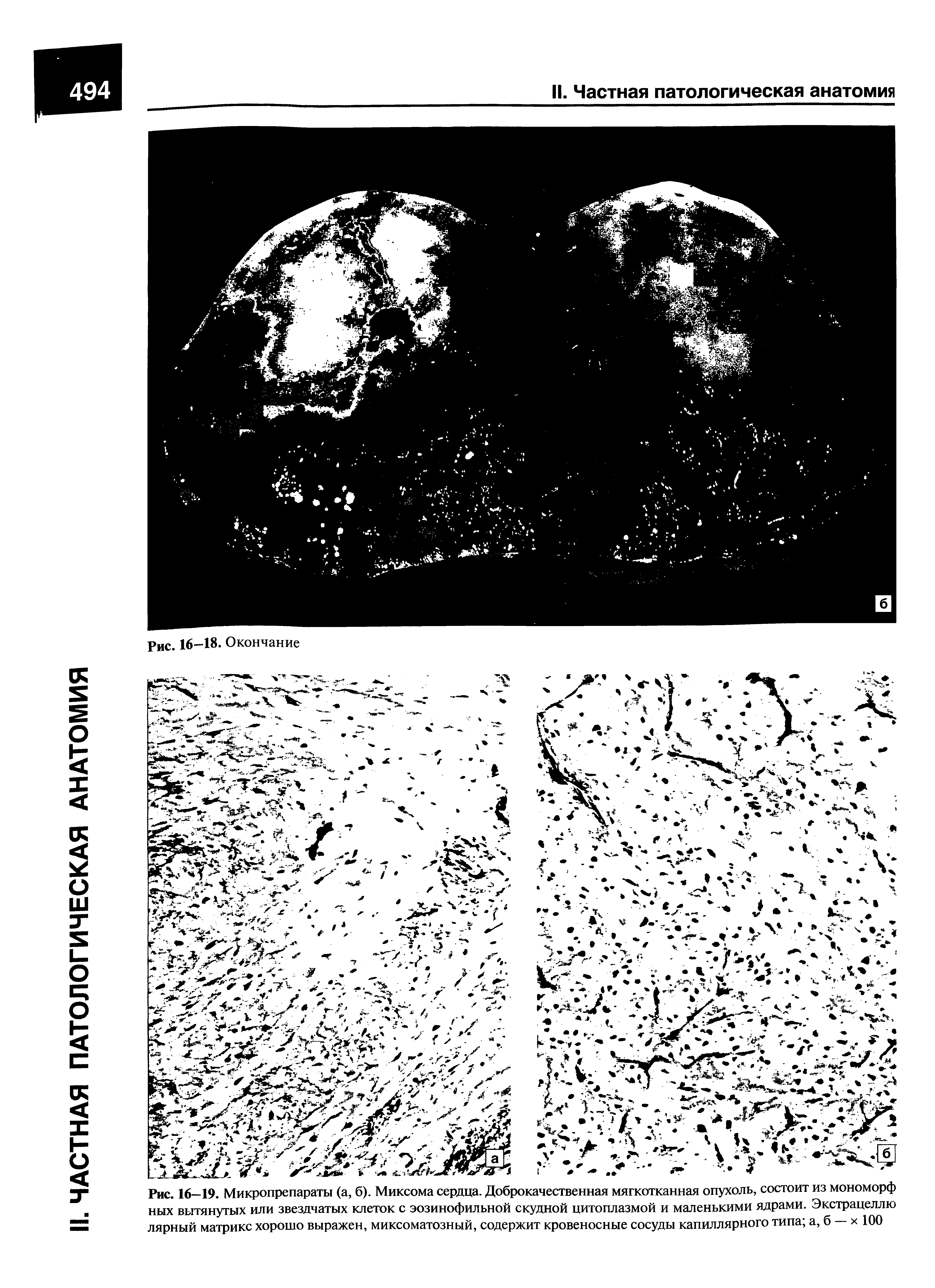 Рис. 16—19. Микропрепараты (а, б). Миксома сердца. Доброкачественная мягкотканная опухоль, состоит из мономорф ных вытянутых или звездчатых клеток с эозинофильной скудной цитоплазмой и маленькими ядрами. Экстрацеллю лярный матрикс хорошо выражен, миксоматозный, содержит кровеносные сосуды капиллярного типа а, б — х 100...