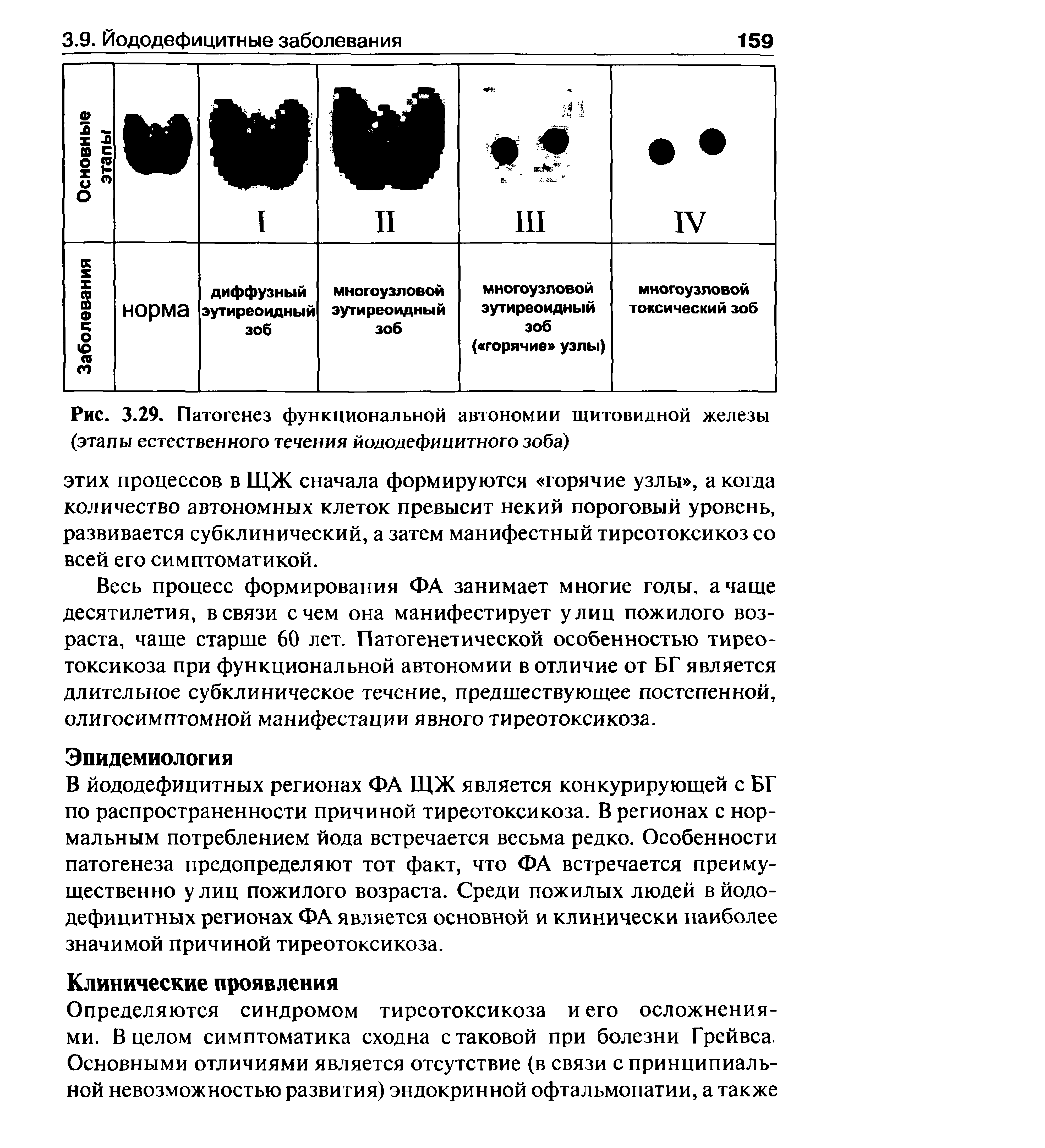 Рис. 3.29. Патогенез функциональной автономии щитовидной железы (этапы естественного течения йододефи и итного зоба)...