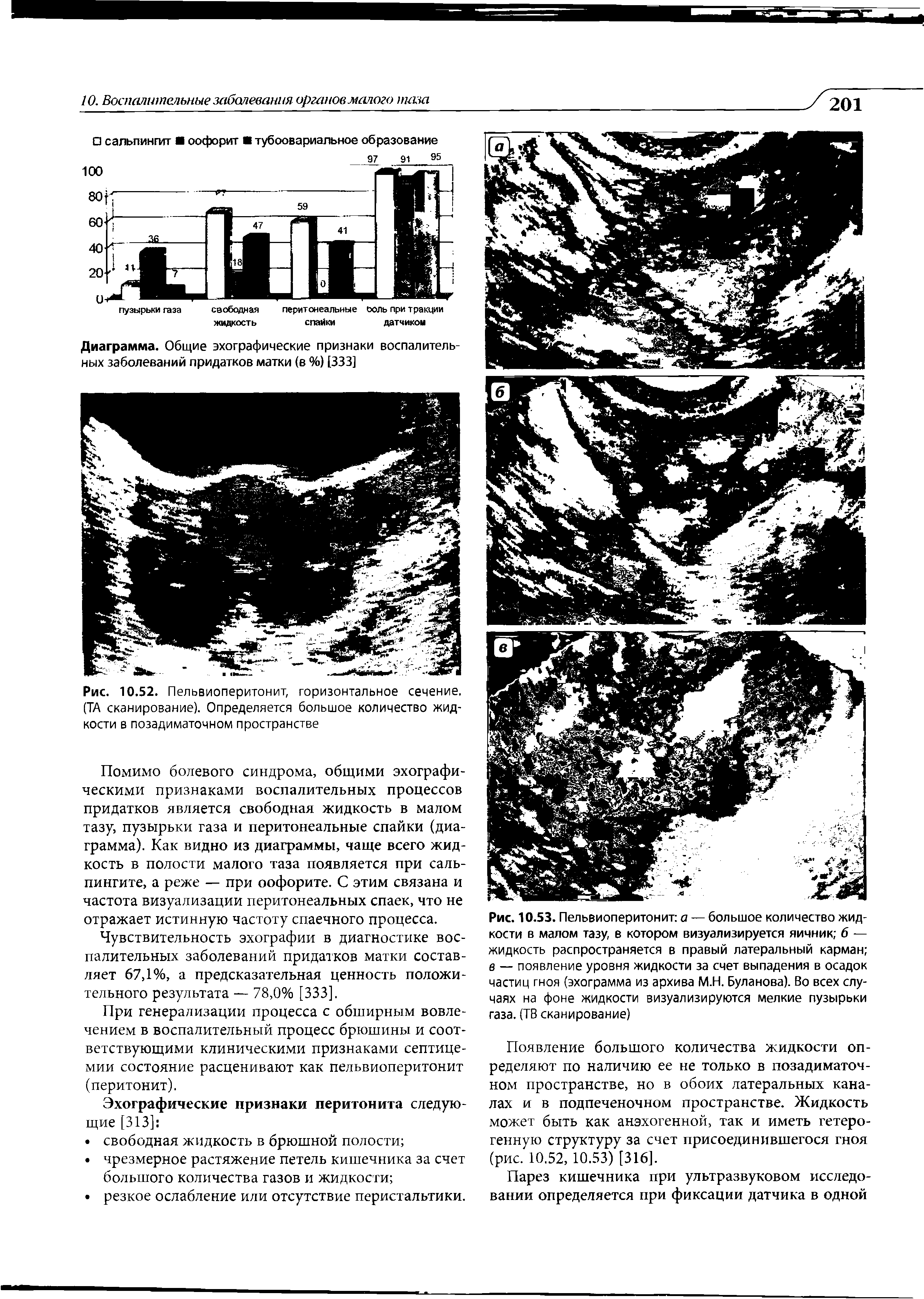Рис. 10.53. Пельвиоперитонит а — большое количество жидкости в малом тазу, в котором визуализируется яичник 6 — жидкость распространяется в правый латеральный карман в — появление уровня жидкости за счет выпадения в осадок частиц гноя (эхограмма из архива М.Н. Буланова). Во всех случаях на фоне жидкости визуализируются мелкие пузырьки газа. (ТВ сканирование)...