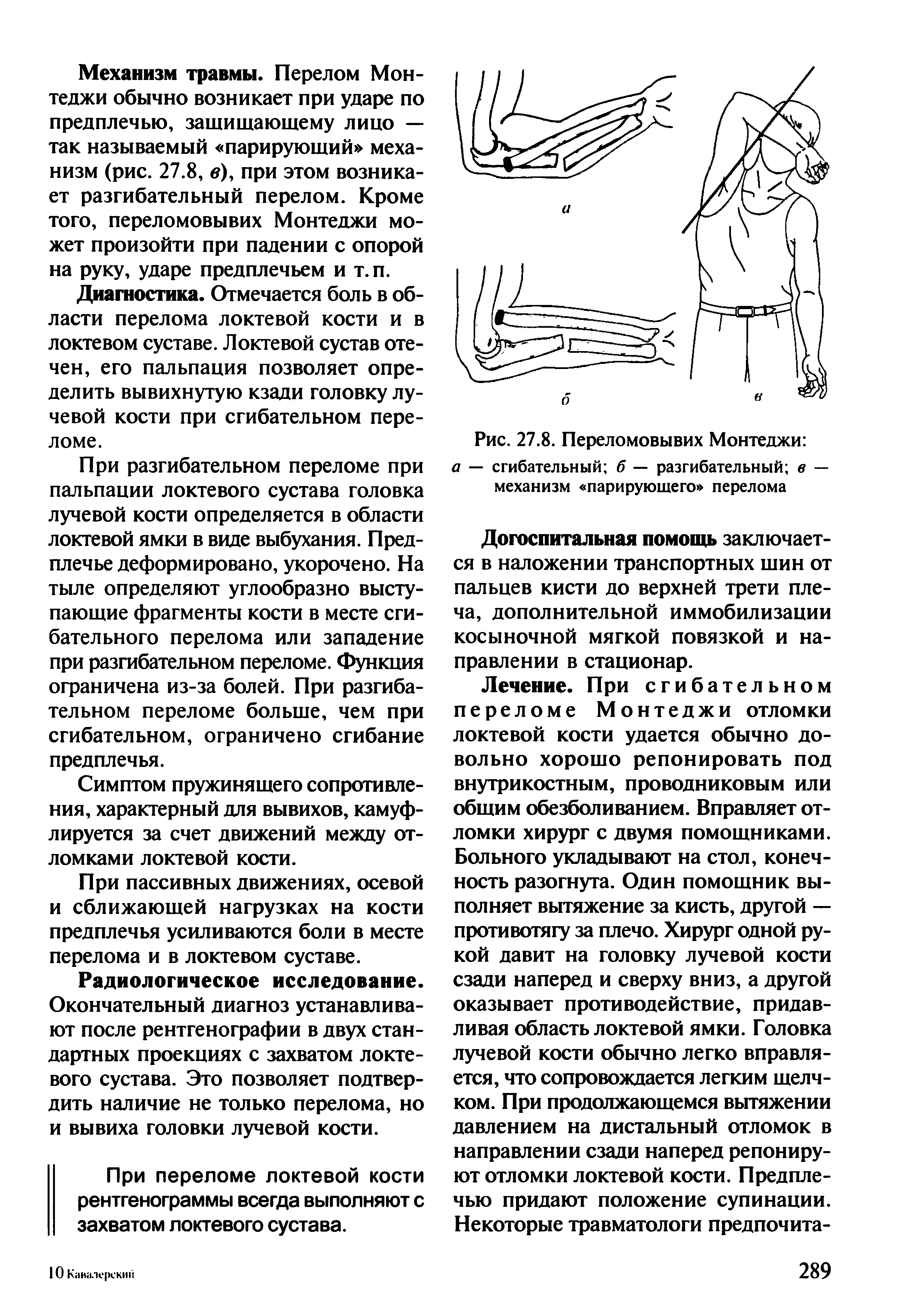 Рис. 27.8. Переломовывих Монтеджи а — сгибательный б — разгибательный в — механизм парирующего перелома...