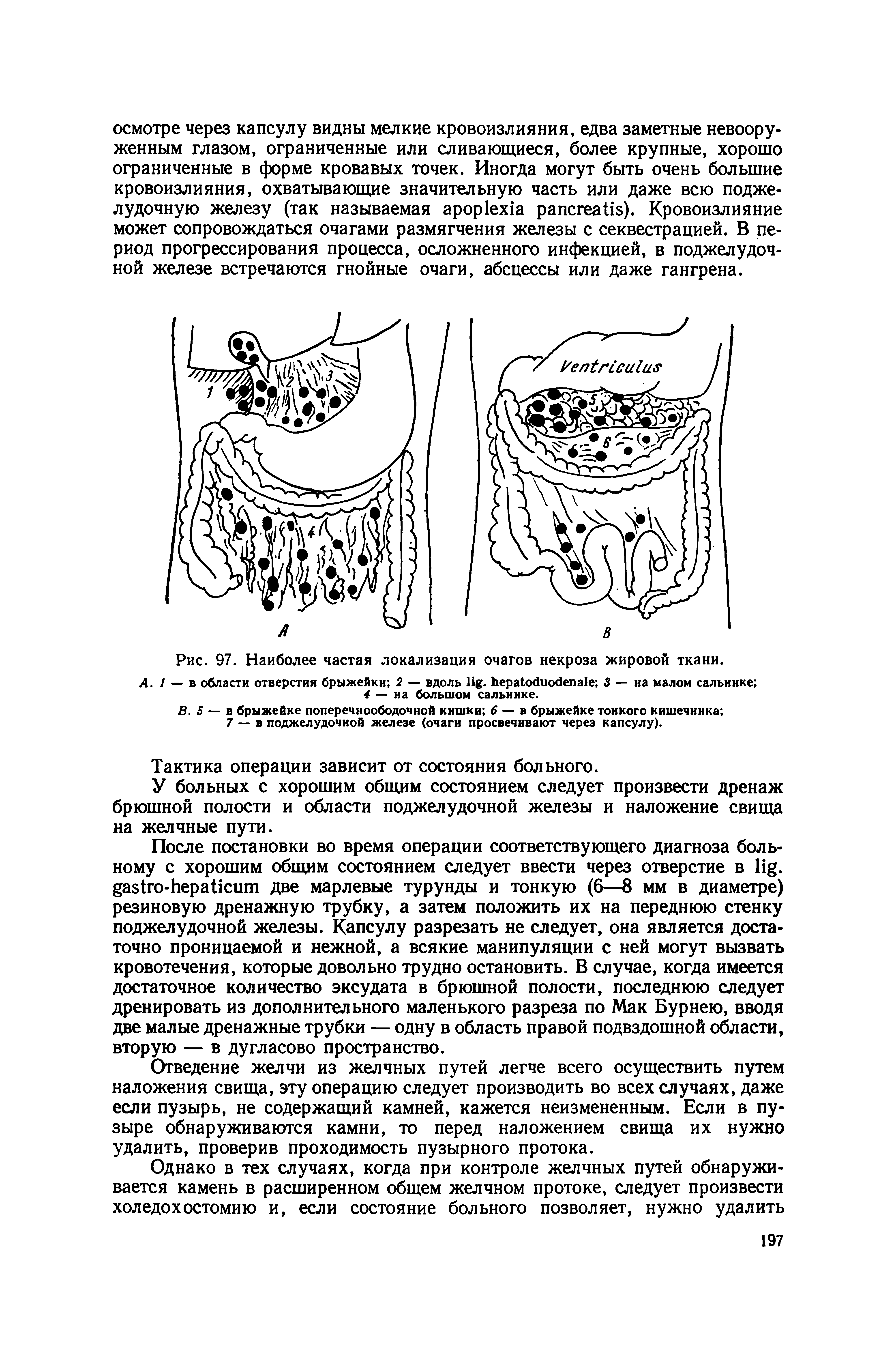 Рис. 97. Наиболее частая локализация очагов некроза жировой ткани.