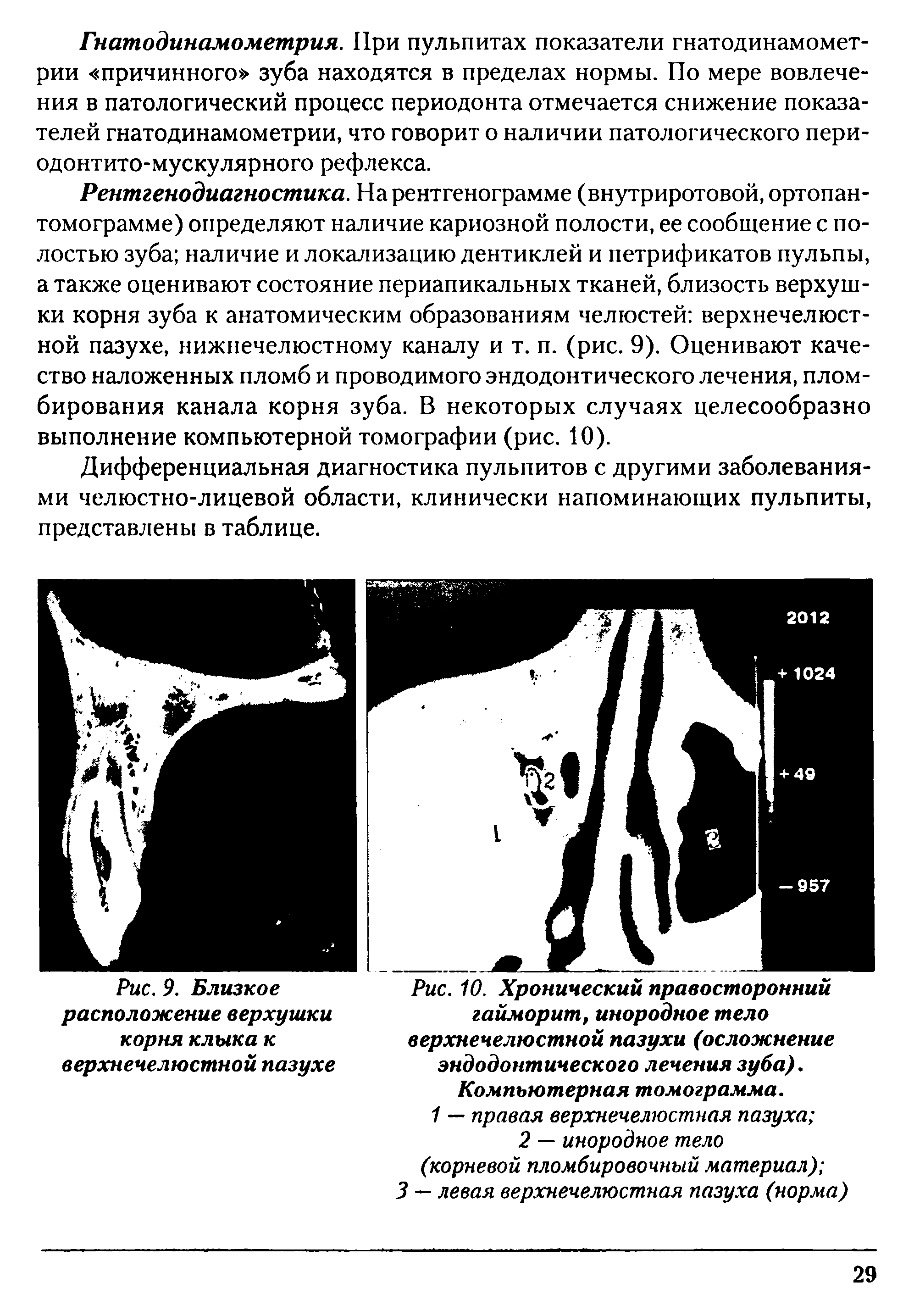 Рис. 10. Хронический правосторонний гайморит, инородное тело верхнечелюстной пазухи (осложнение эндодонтического лечения зуба). Компьютерная томограмма.