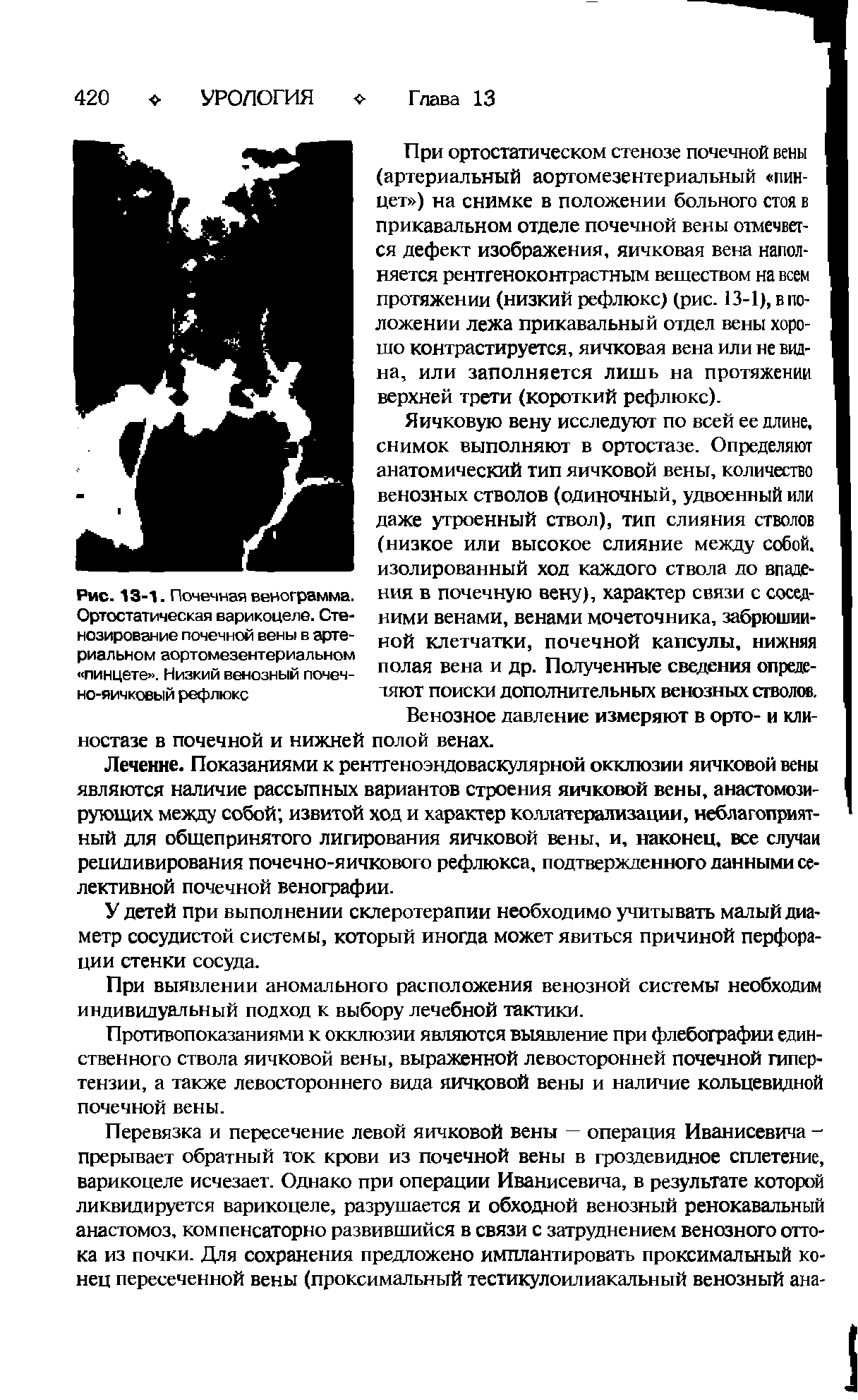 Рис. 13-1. Почечная венограмма. Ортостатическая варикоцеле. Стенозирование почечной вены в артериальном аортомезентериальном пинцете . Низкий венозный почечно-яичковый рефлюкс...