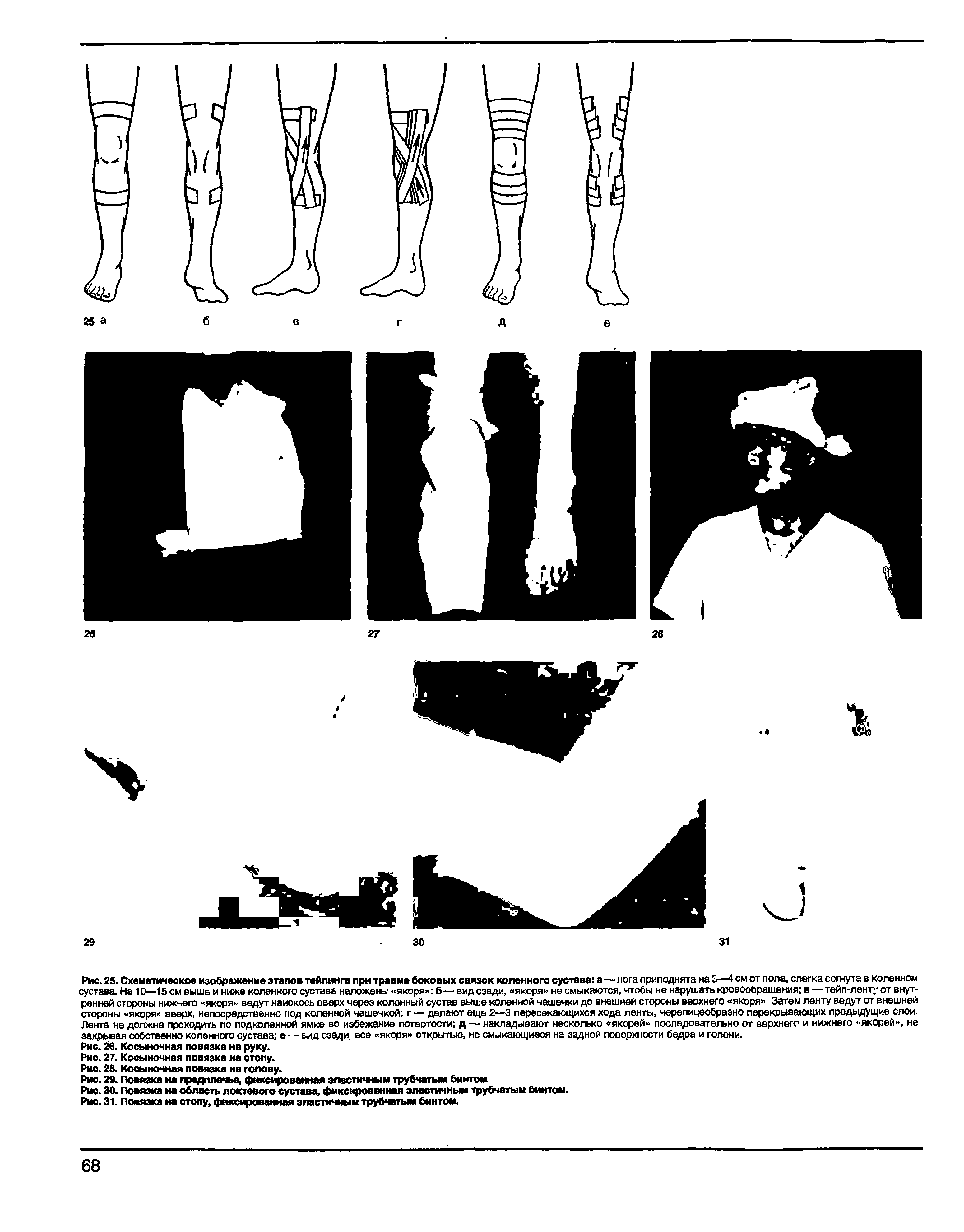 Рис. 31. Повязка на стопу, фиксированная эластичным трубчатым бинтом.