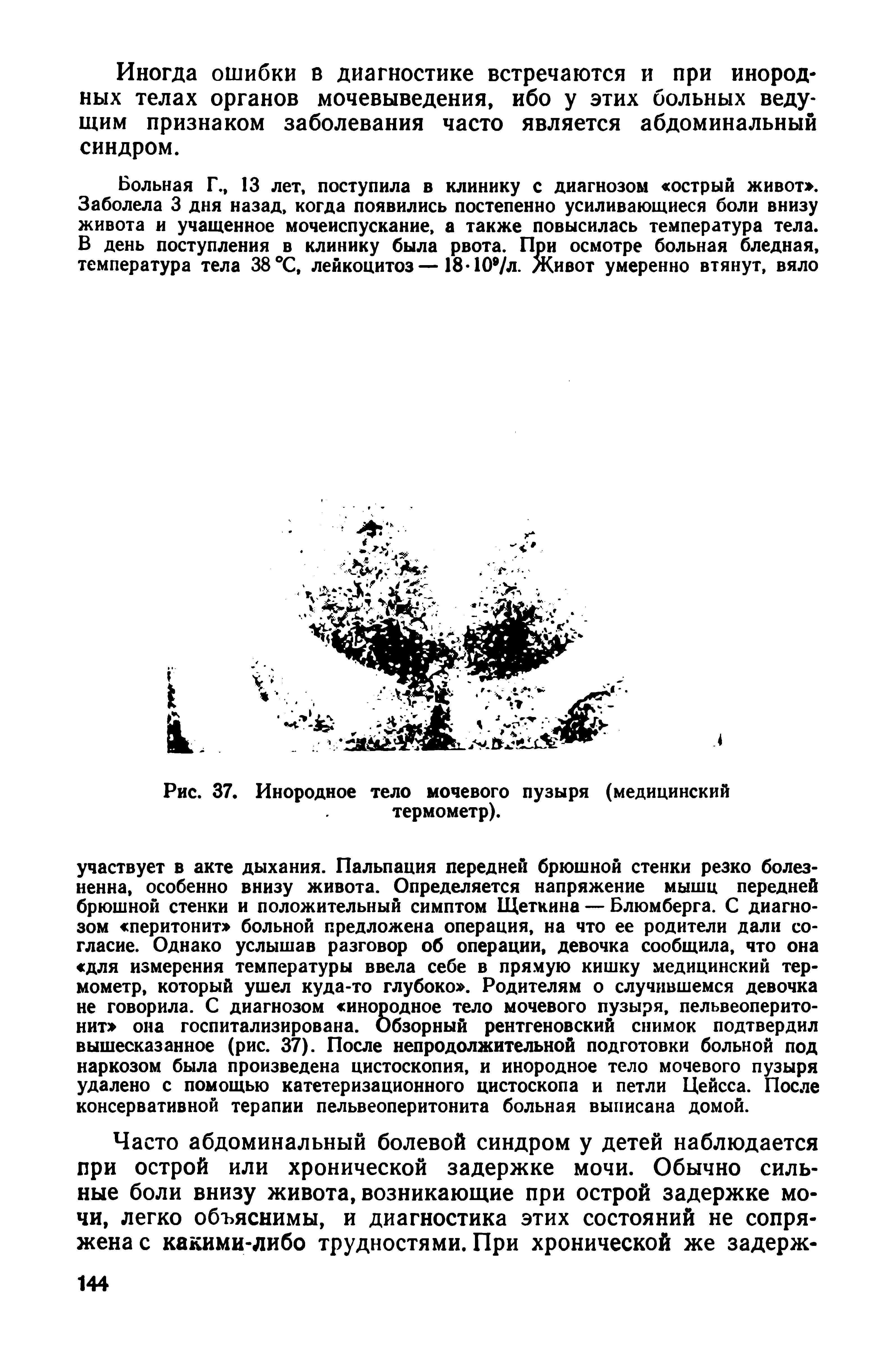 Рис. 37. Инородное тело мочевого пузыря (медицинский термометр).