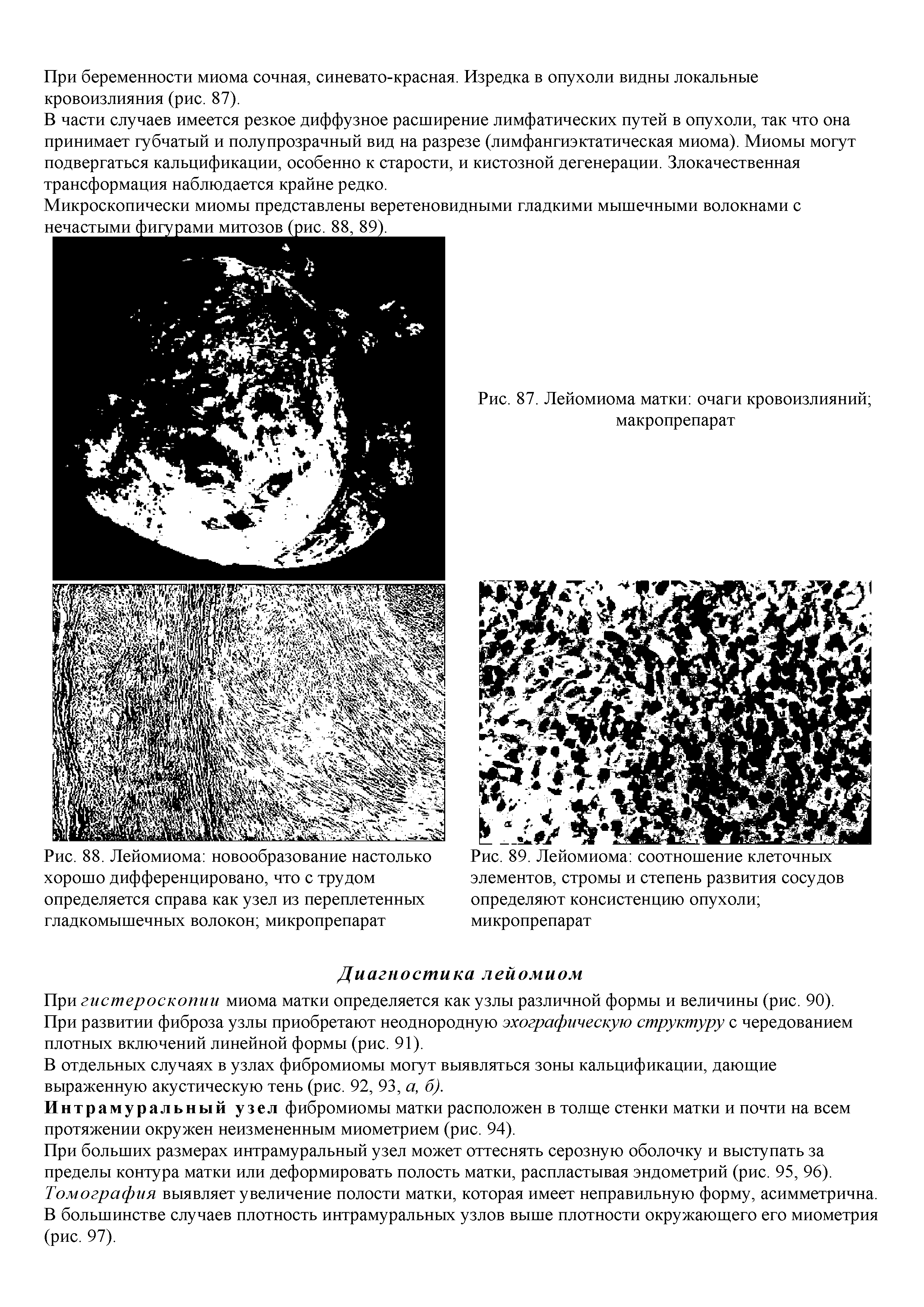 Рис. 89. Лейомиома соотношение клеточных элементов, стромы и степень развития сосудов определяют консистенцию опухоли микропрепарат...