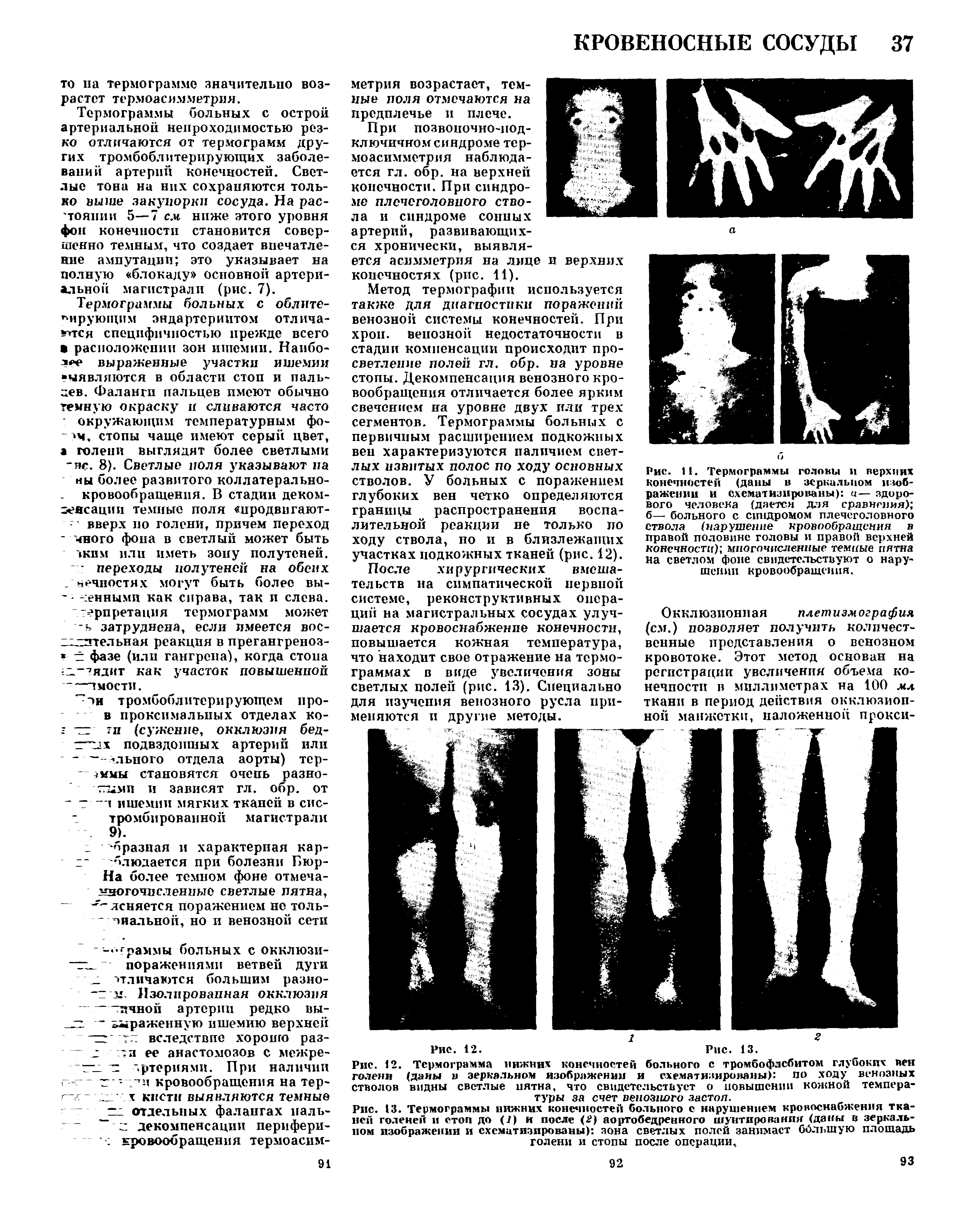 Рис. 13. Термограммы нижних конечностей больного с нарушением кровоснабжения тканей голеней и стоп до ( ) и после (2) аортобедренного шунтирования (даны в зеркальном изображении и схематизированы) зона светлых полей занимает большую площадь голени и стопы после операции,...