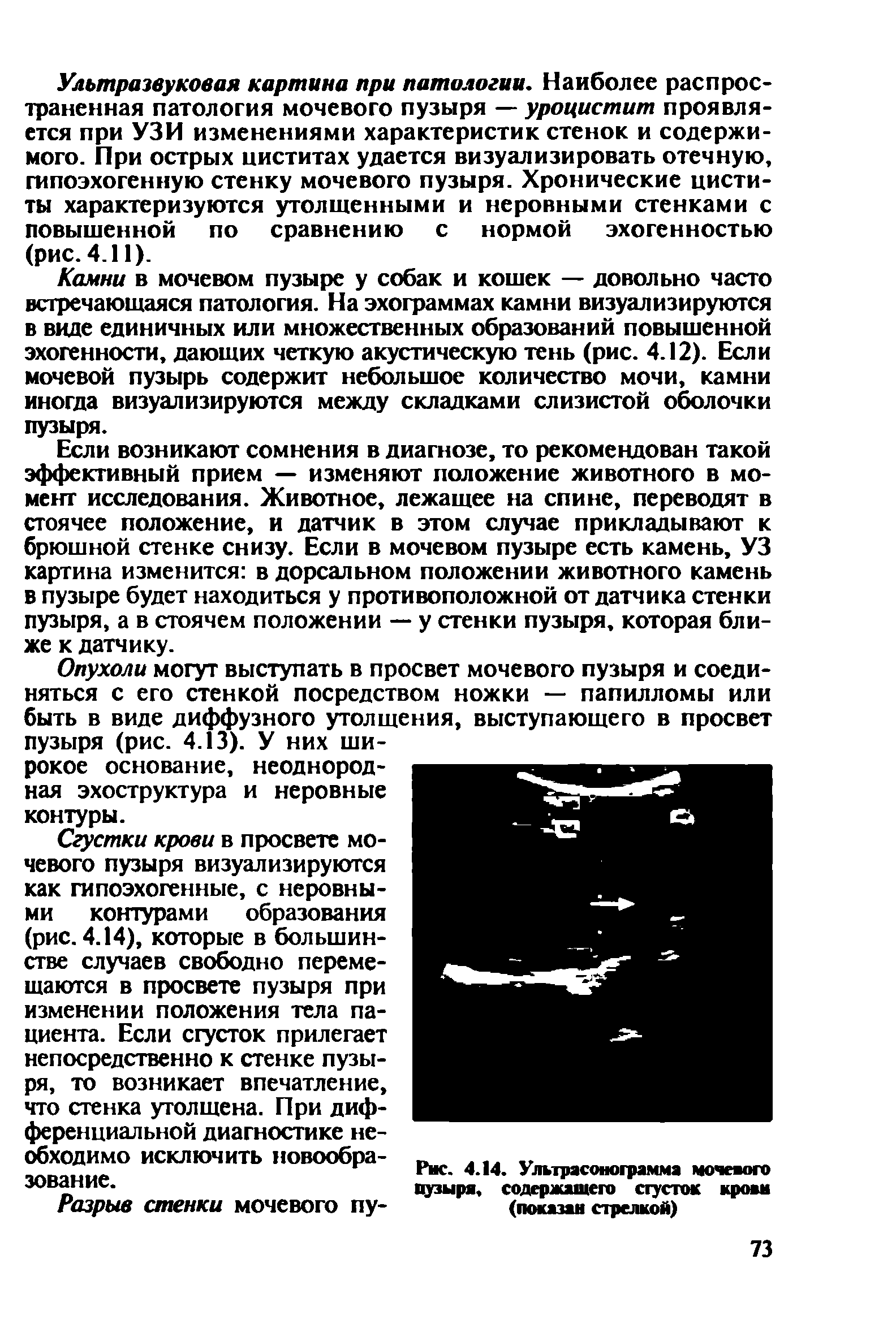 Рис. 4.14. Улырасонограмма мочевого пузыря, содержащего сгусток крови (показан стрелкой)...