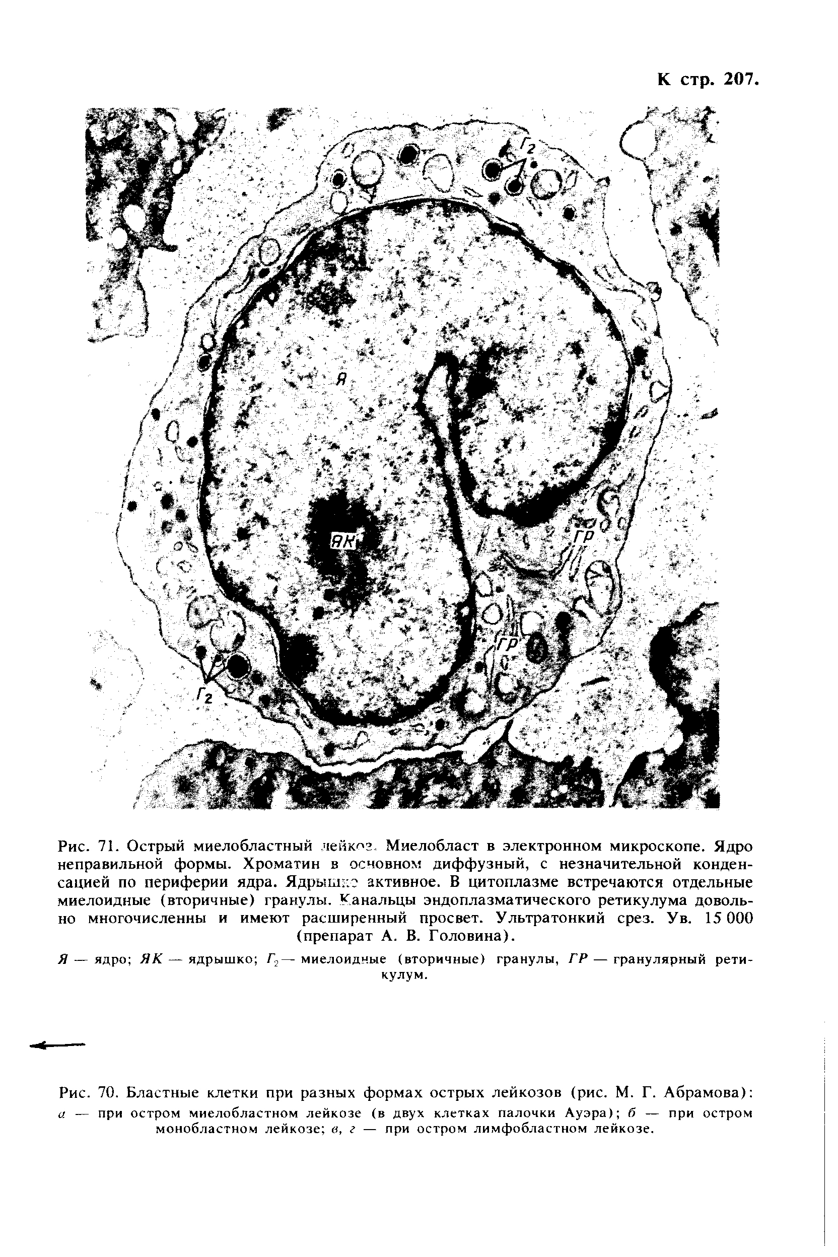 Рис. 70. Бластные клетки при разных формах острых лейкозов (рис. М. Г. Абрамова) а — при остром миелобластном лейкозе (в двух клетках палочки Ауэра) б — при остром монобластном лейкозе в, г — при остром лимфобластном лейкозе.