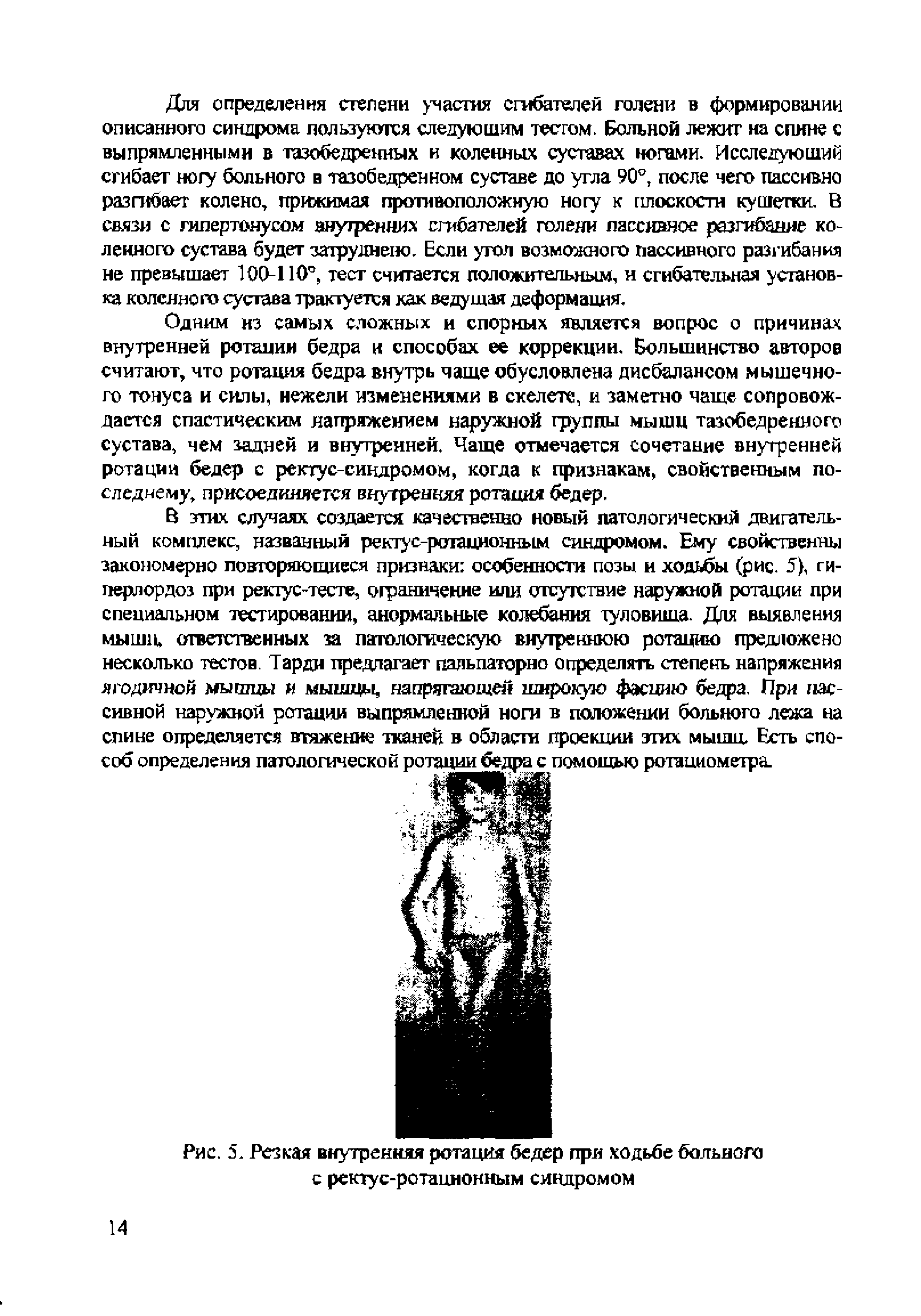 Рис. 5. Резкая внутренняя ротация бедер при ходьбе больного...