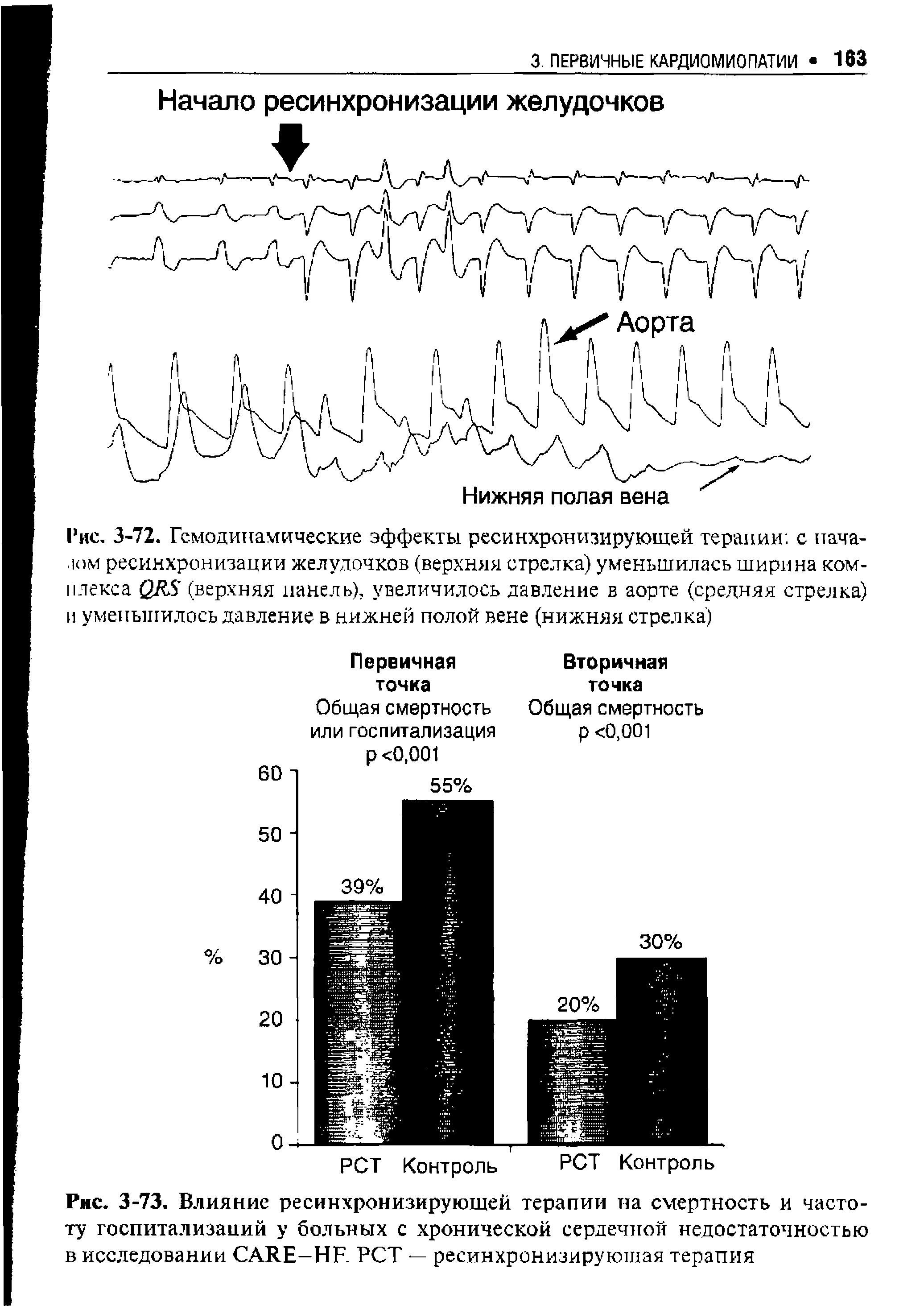 Рис. 3-73. Влияние ресинхронизирующей терапии на смертность и частоту госпитализаций у больных с хронической сердечной недостаточностью в исследовании CARE-HF. РСТ — ресинхронизируюшая терапия...